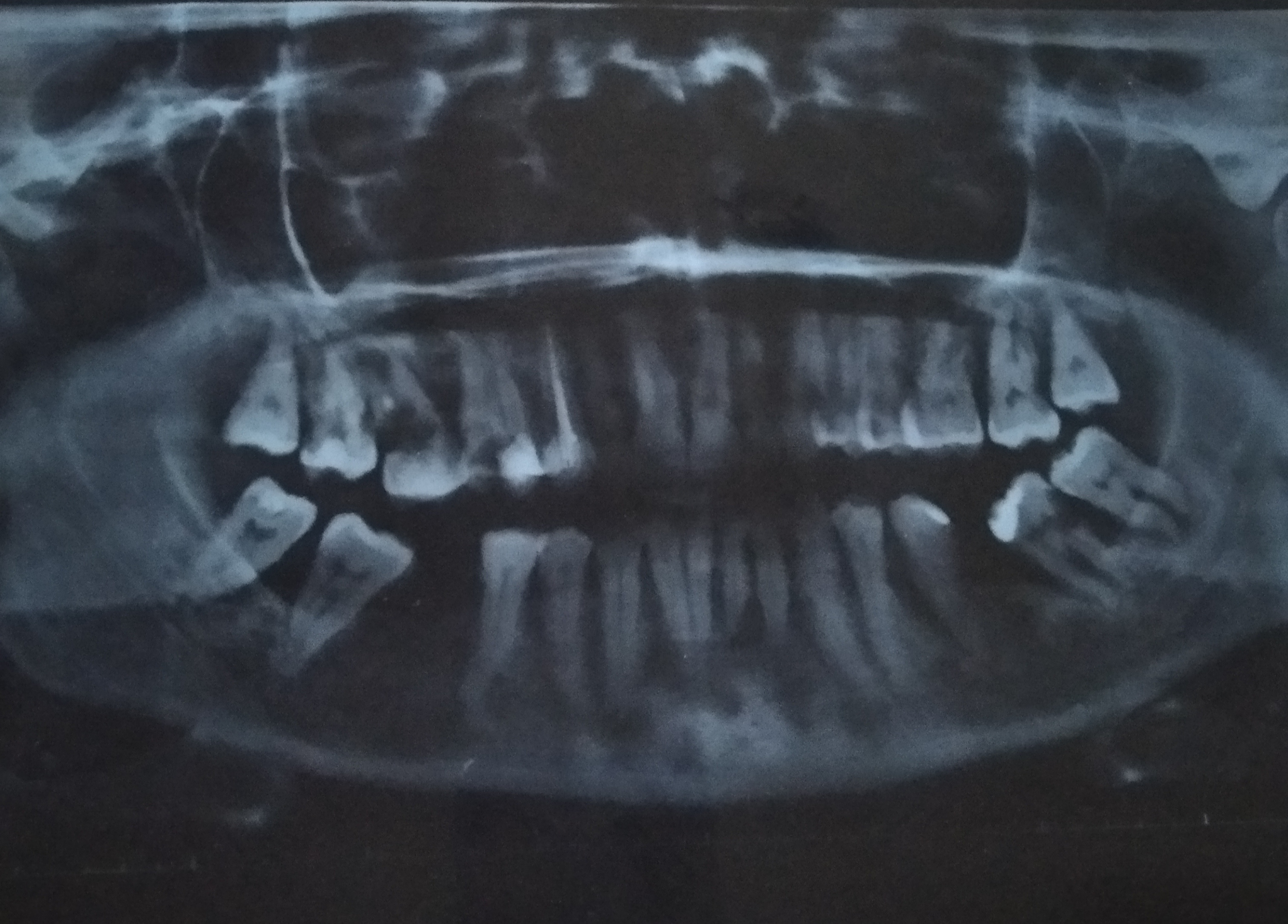 Mi è stata diagnosticata la parodontite