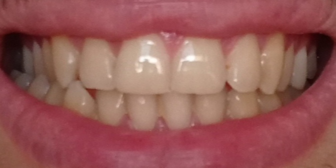 È possibile alla mia età correggere il problema con l'ortodonzia?