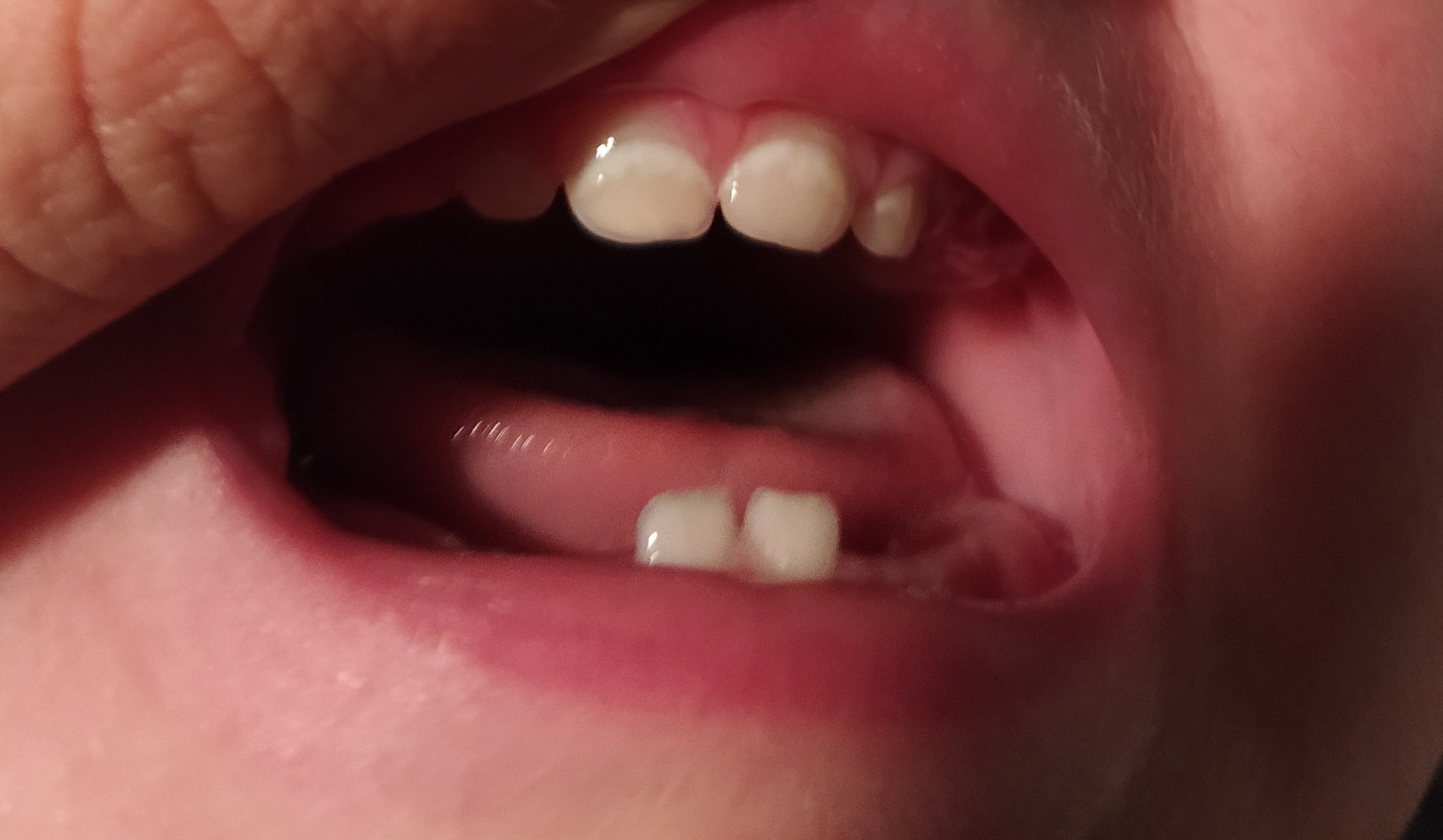 Quale potrebbe essere la causa delle macchie che compaiono sui 4 dentini dell'arcata superiore?