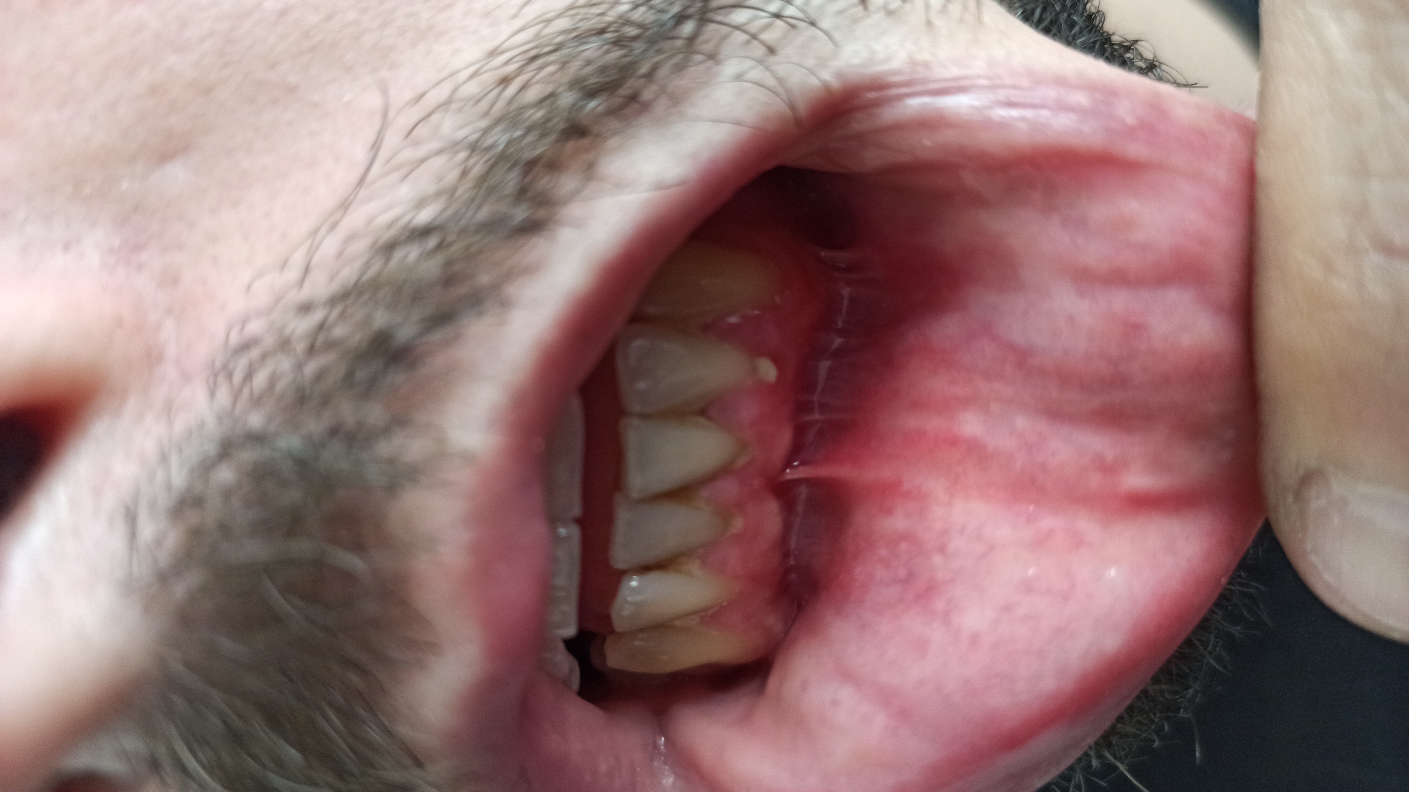 Nella gengiva sotto al dente, è apparso un pezzo bianco