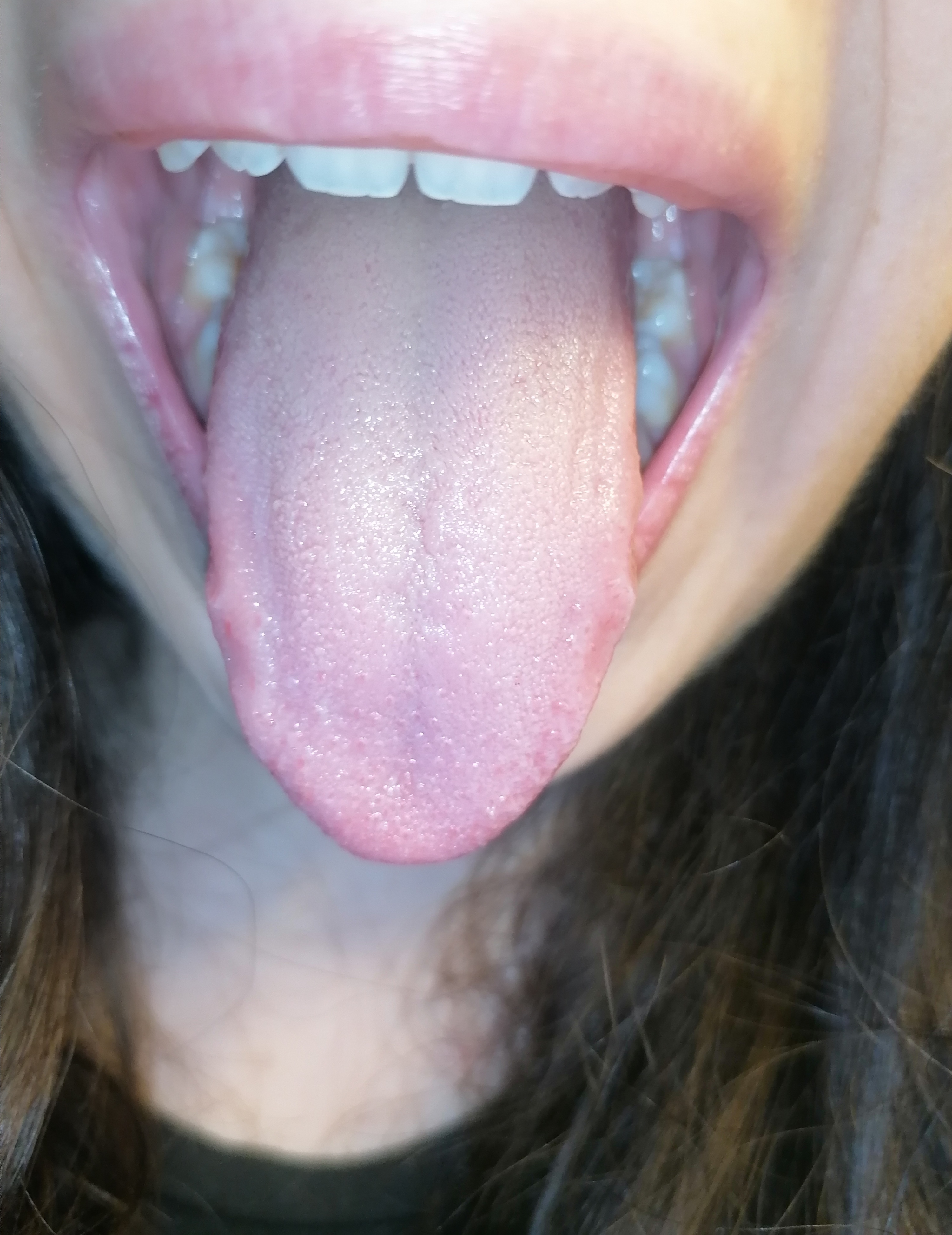 Escrescenze rosse sulla lingua