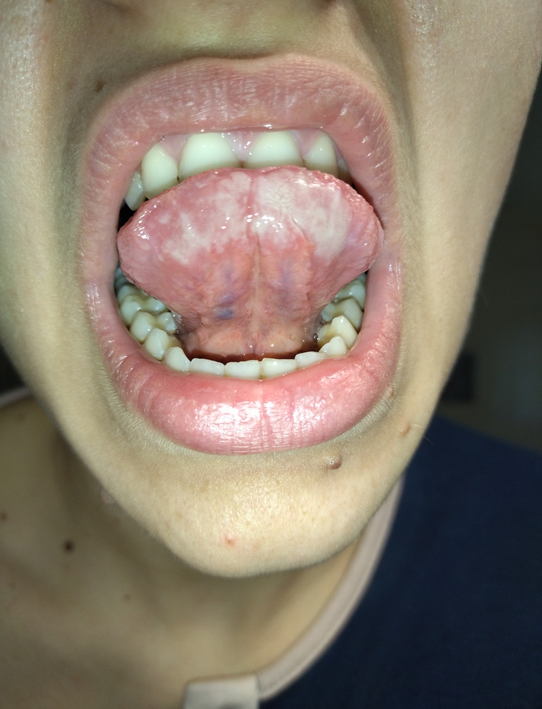 Da ormai 12 anni ho una macchia bianca sotto la lingua
