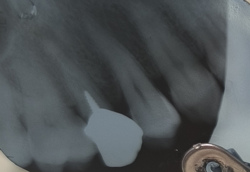 Trattamento granuloma e dente incapsulato