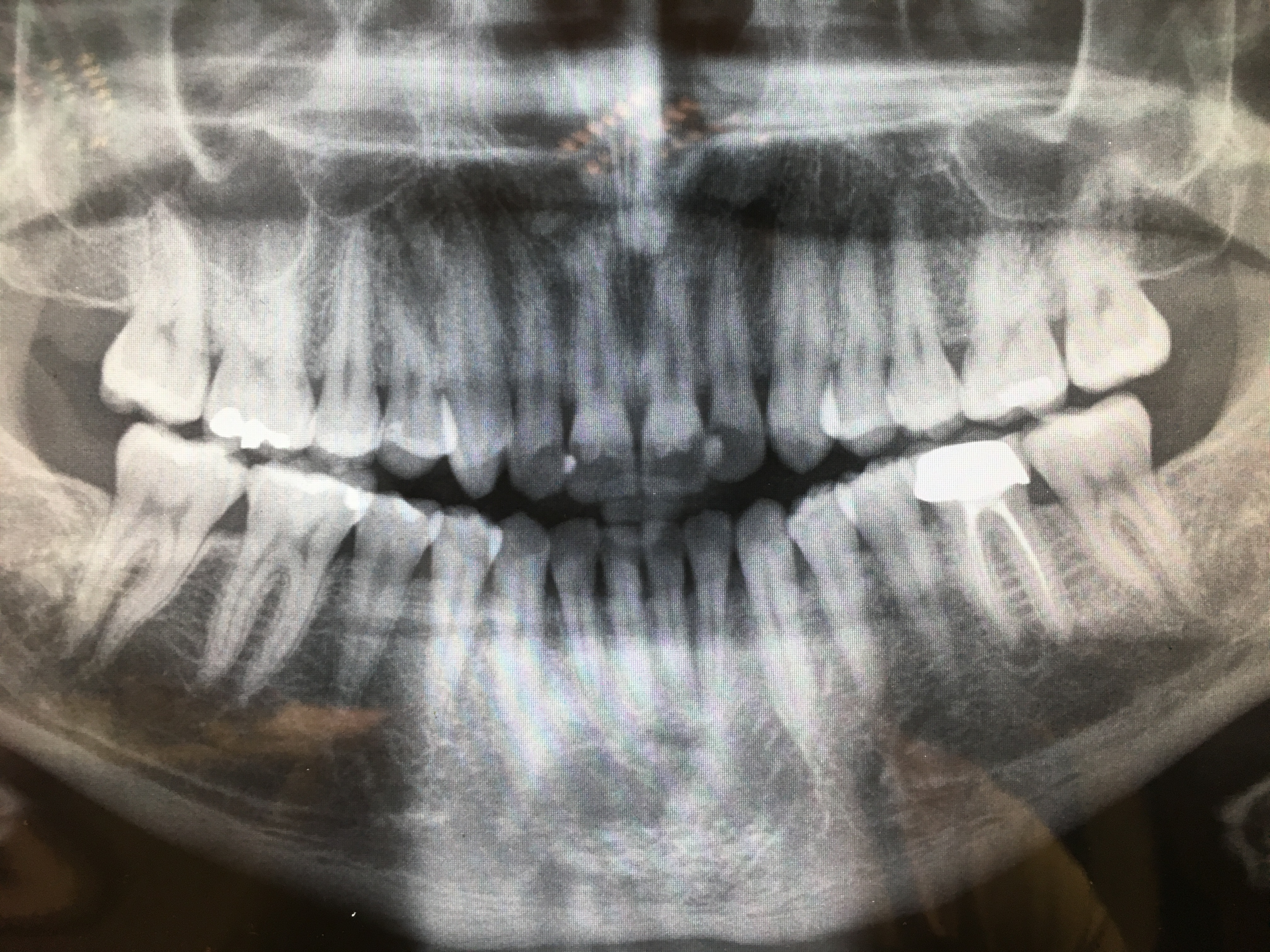 Granuloma  sotto la radice di un dente devitalizzato e incapsulato anni fa