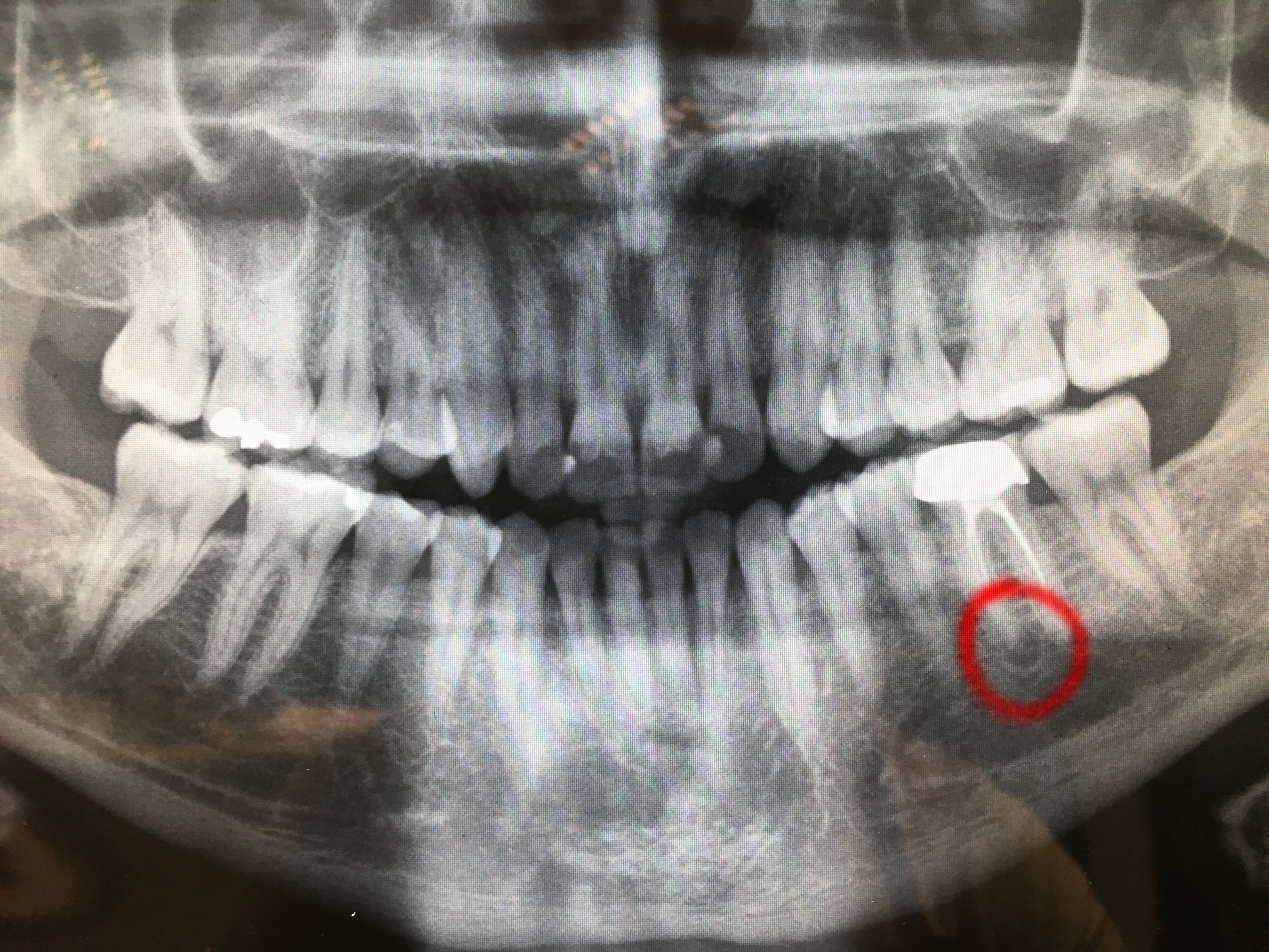 Granuloma  sotto la radice di un dente devitalizzato e incapsulato anni fa