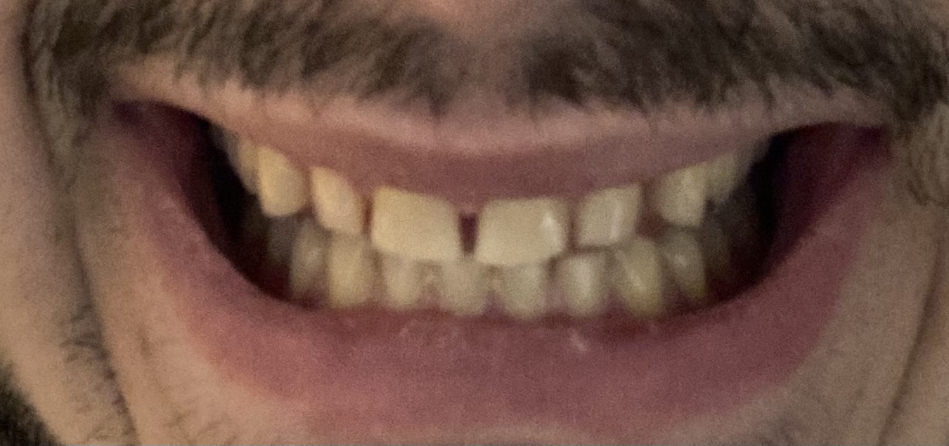 Ho un problema di diastema e denti gialli