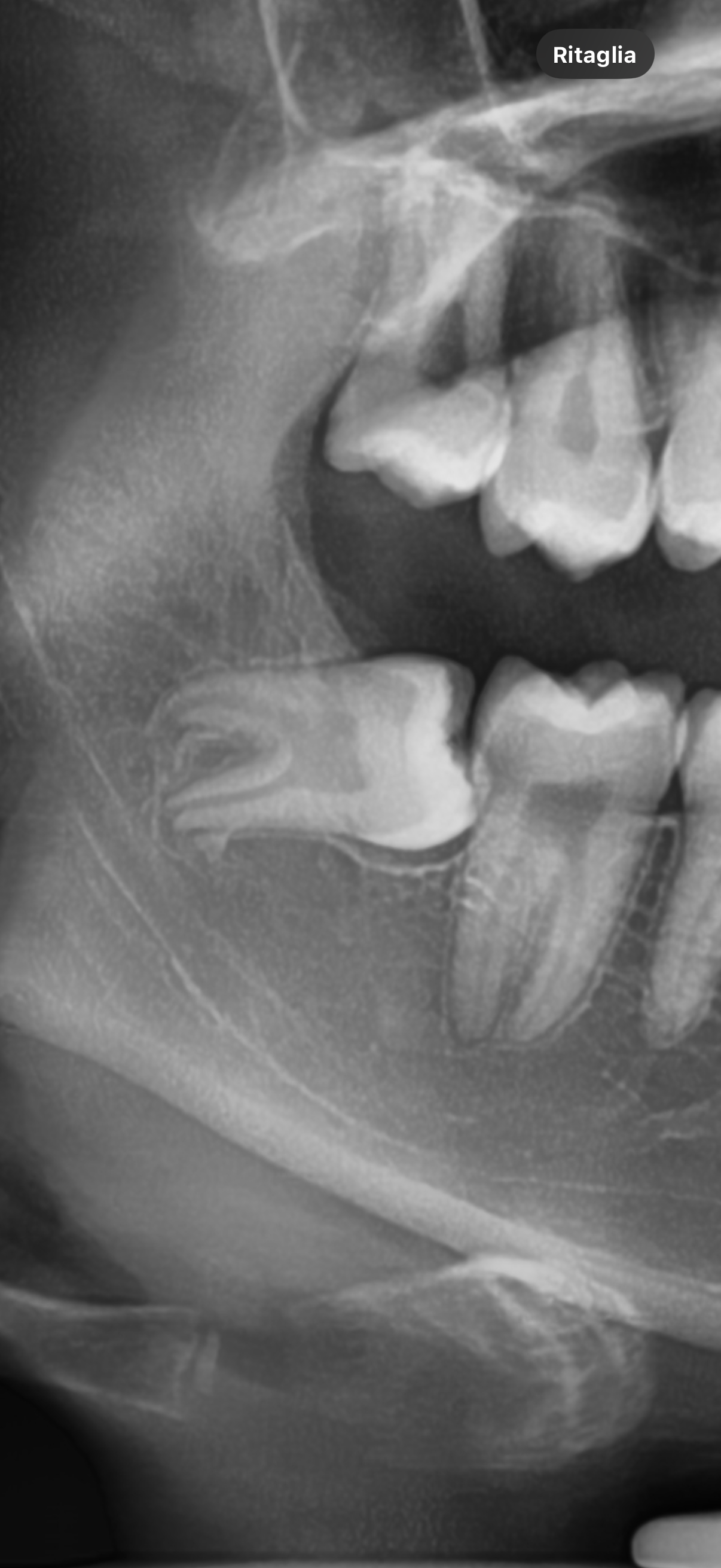 Estrazione del dente del giudizio incluso: Ã¨ corretto rimandare l'intervento?