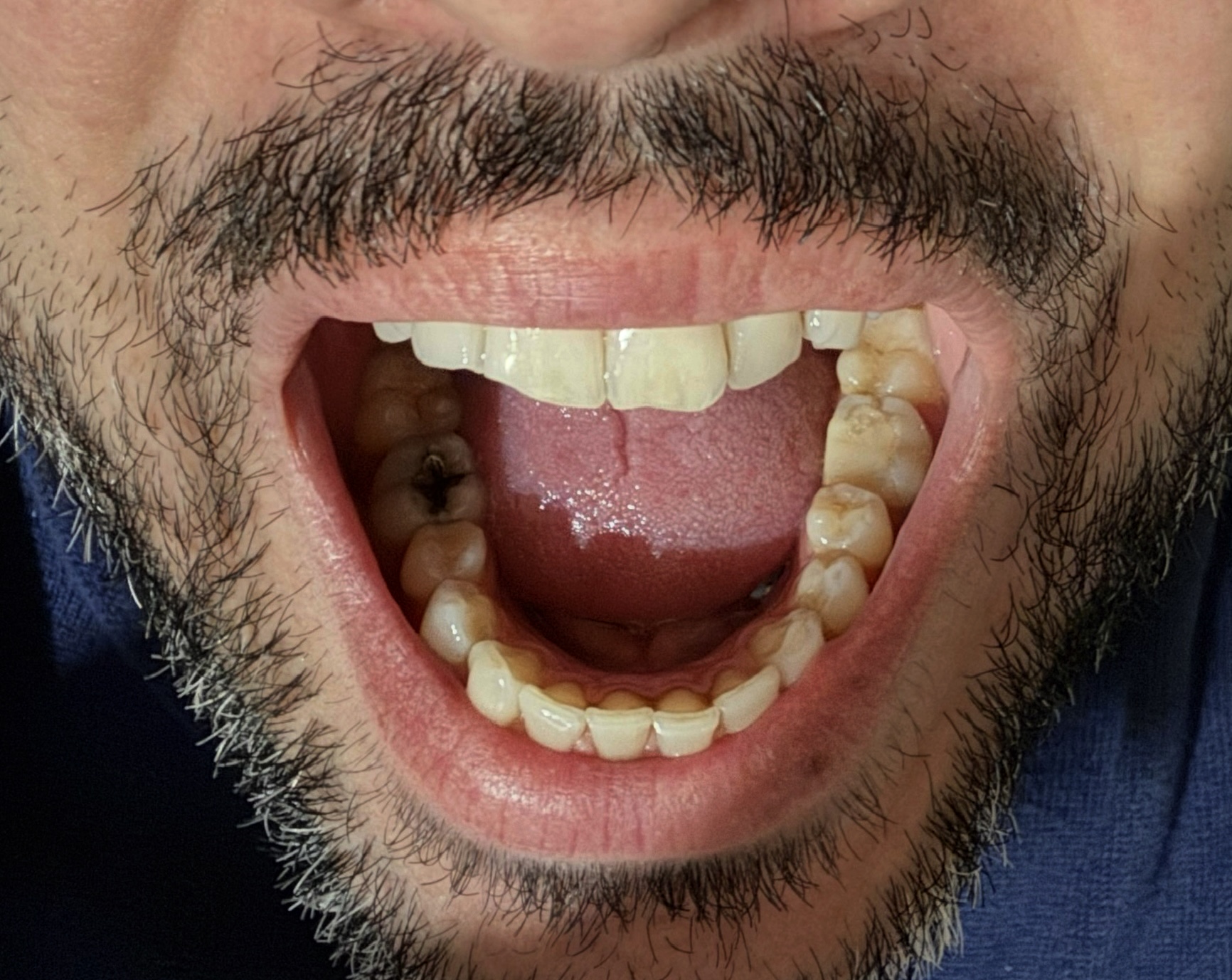 Su un dente devitalizzato (non incapsulato), ho subito una frattura