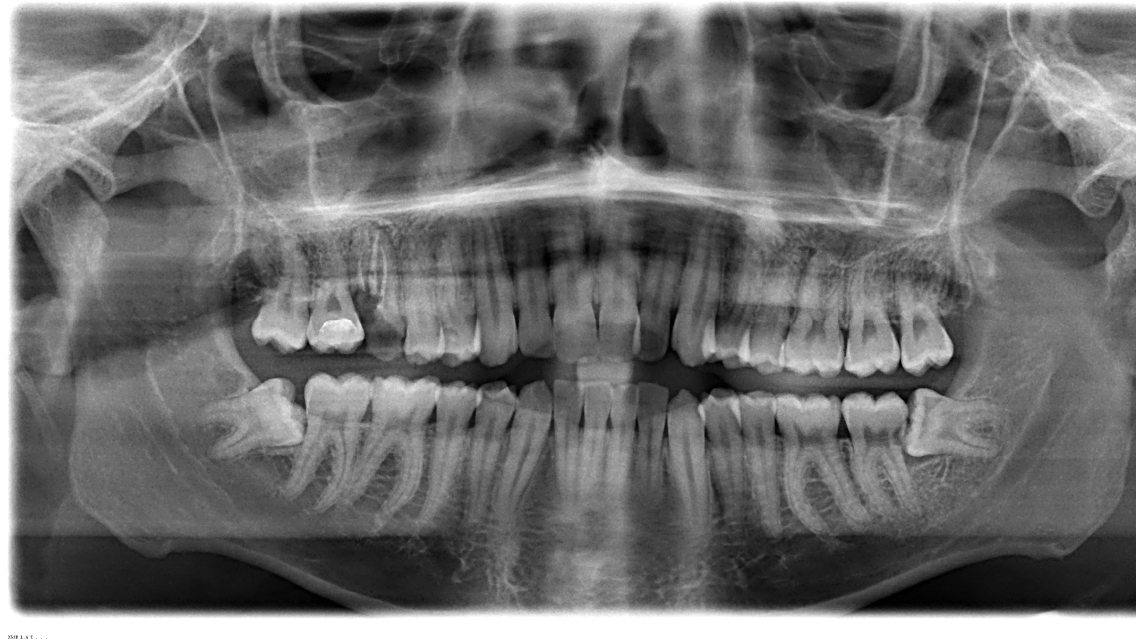 E' necessario toglierli tutti e quattro i denti del giudizio?