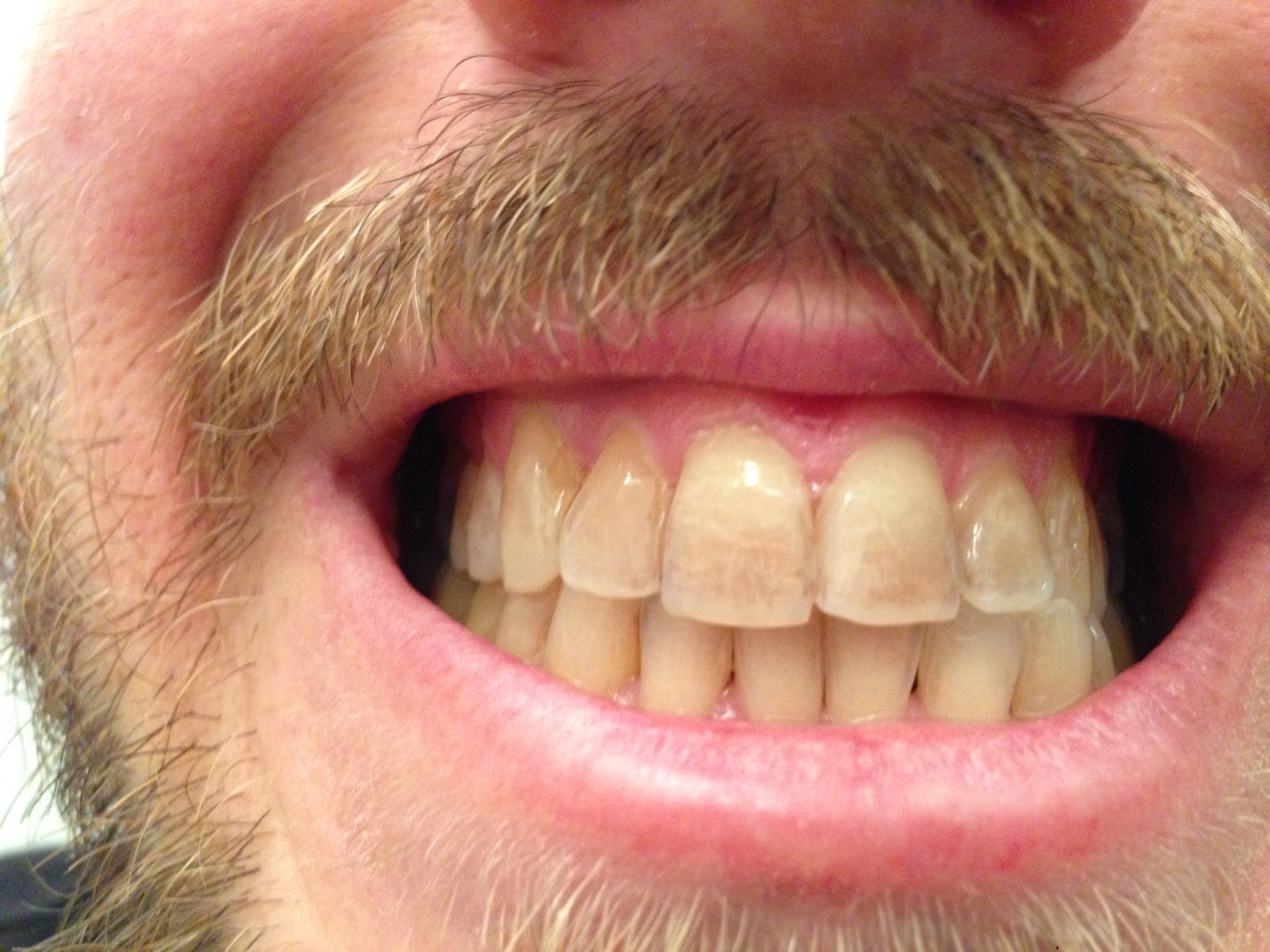 Da qualche anno mi si macchiano i denti con una velocitÃ  inspiegabile.