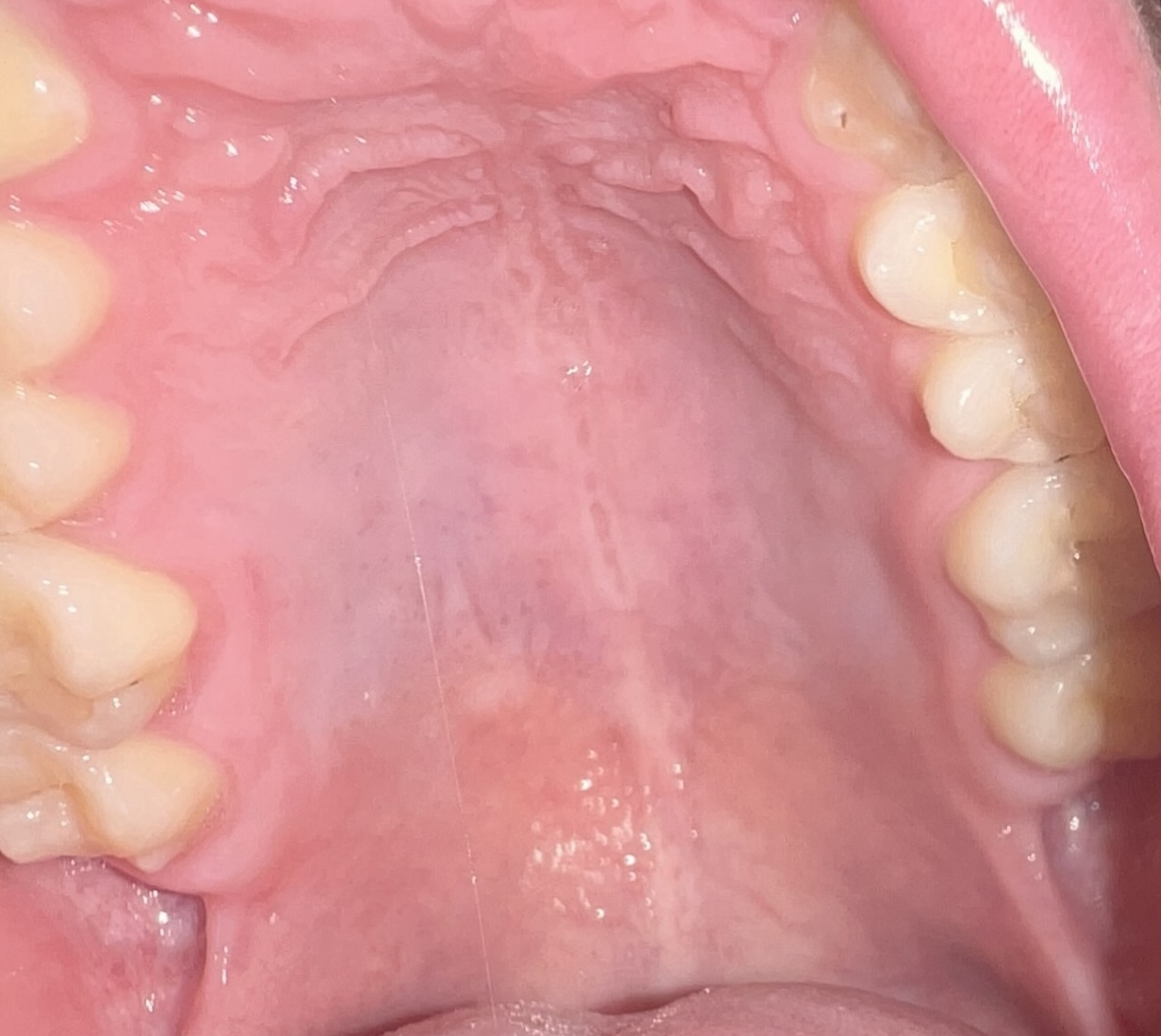 Ho notato in bocca su 3 denti dei puntini neri
