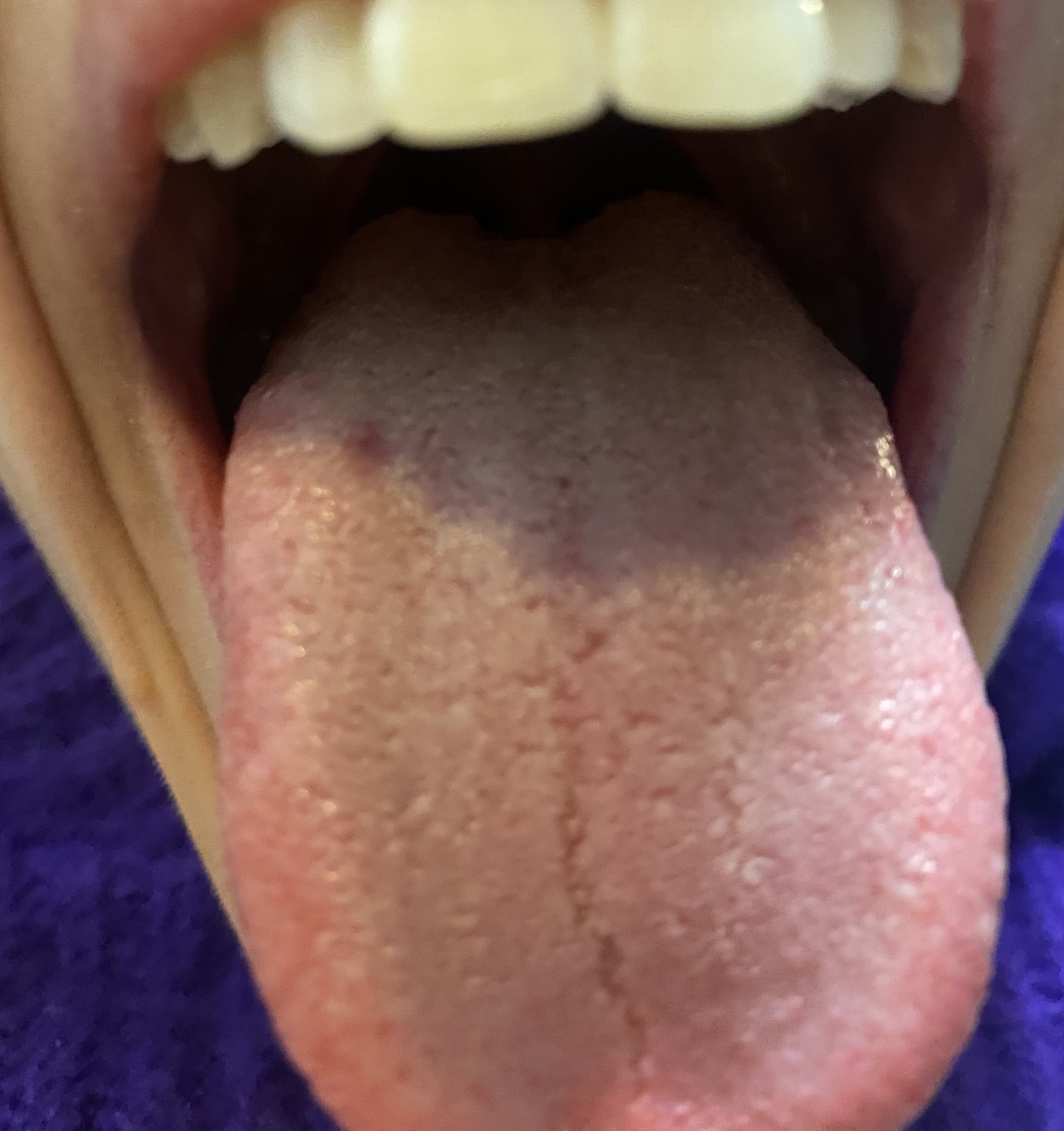 Macchia rossastra indolore sul dorso della lingua