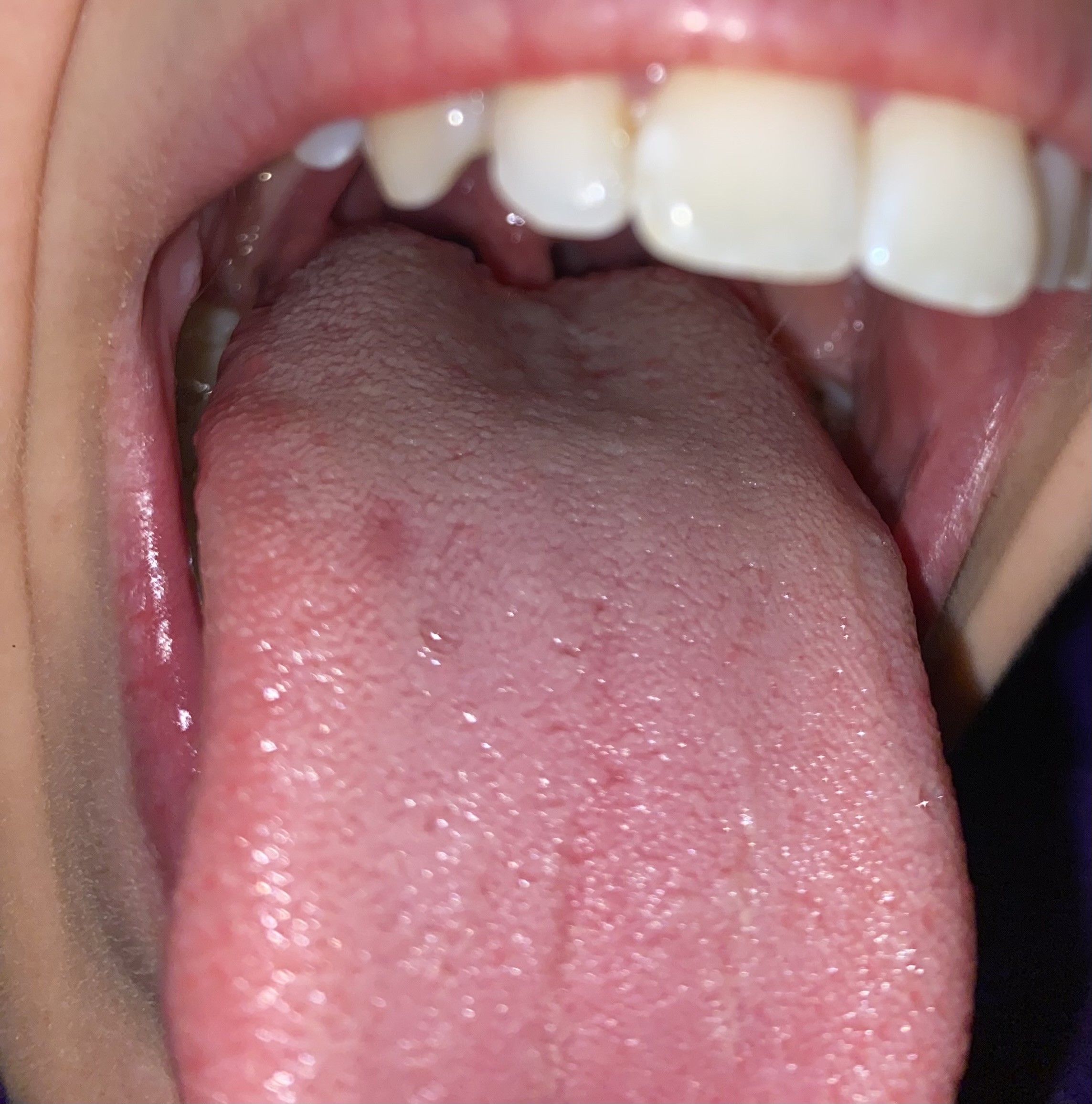 Macchia rossastra indolore sul dorso della lingua