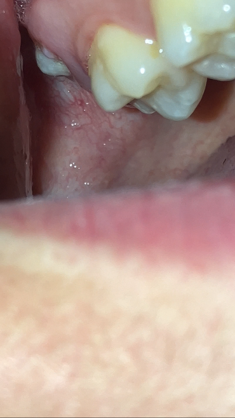 Dente del giudizio: dubbi sull'estrazione