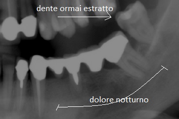 Nell'agosto 2016 ho estratto il dente accanto al ponte