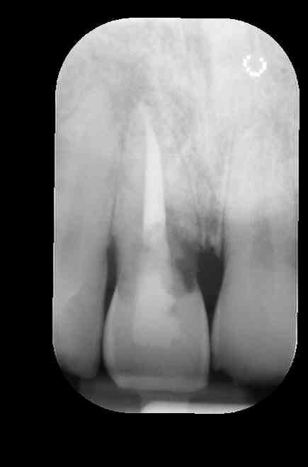 L'unica alternativa è l'estrazione del dente e la sostituzione con uno artificiale?