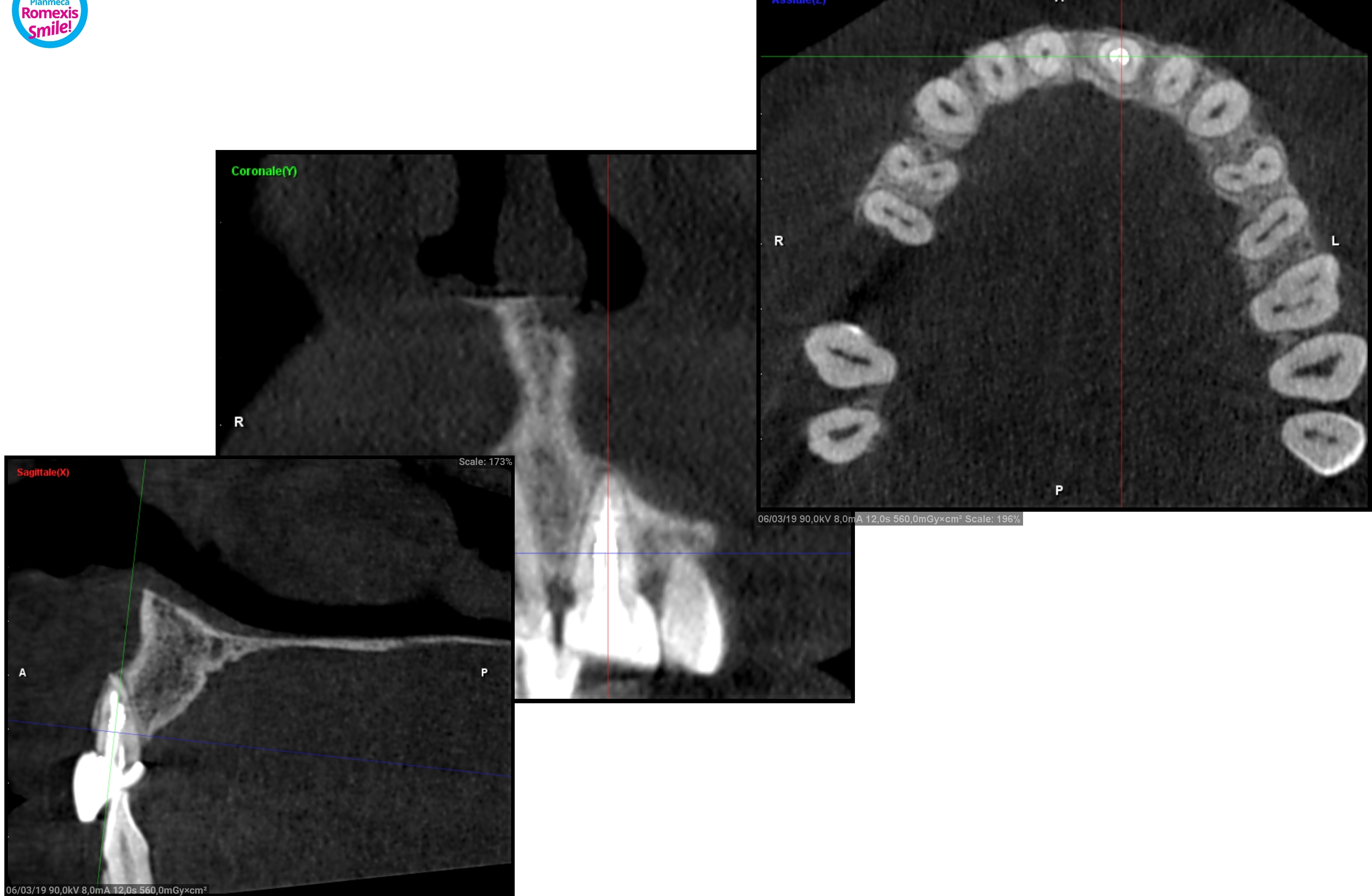 E' necessaria l'estrazione per un riassorbimento in seguito ad una terapia canalare non andata a buon fine?