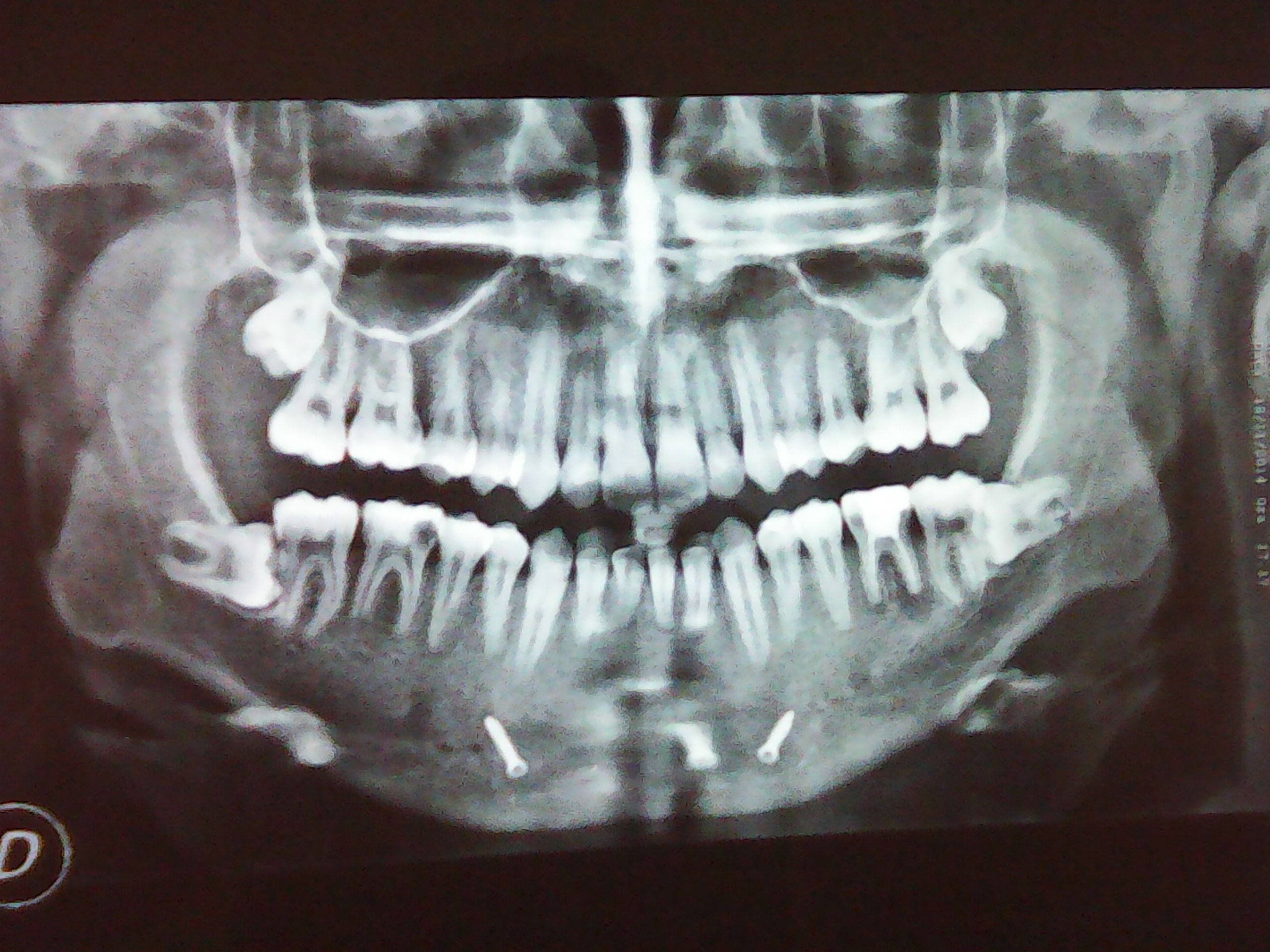 E' necessario un trattamento ortodontico?