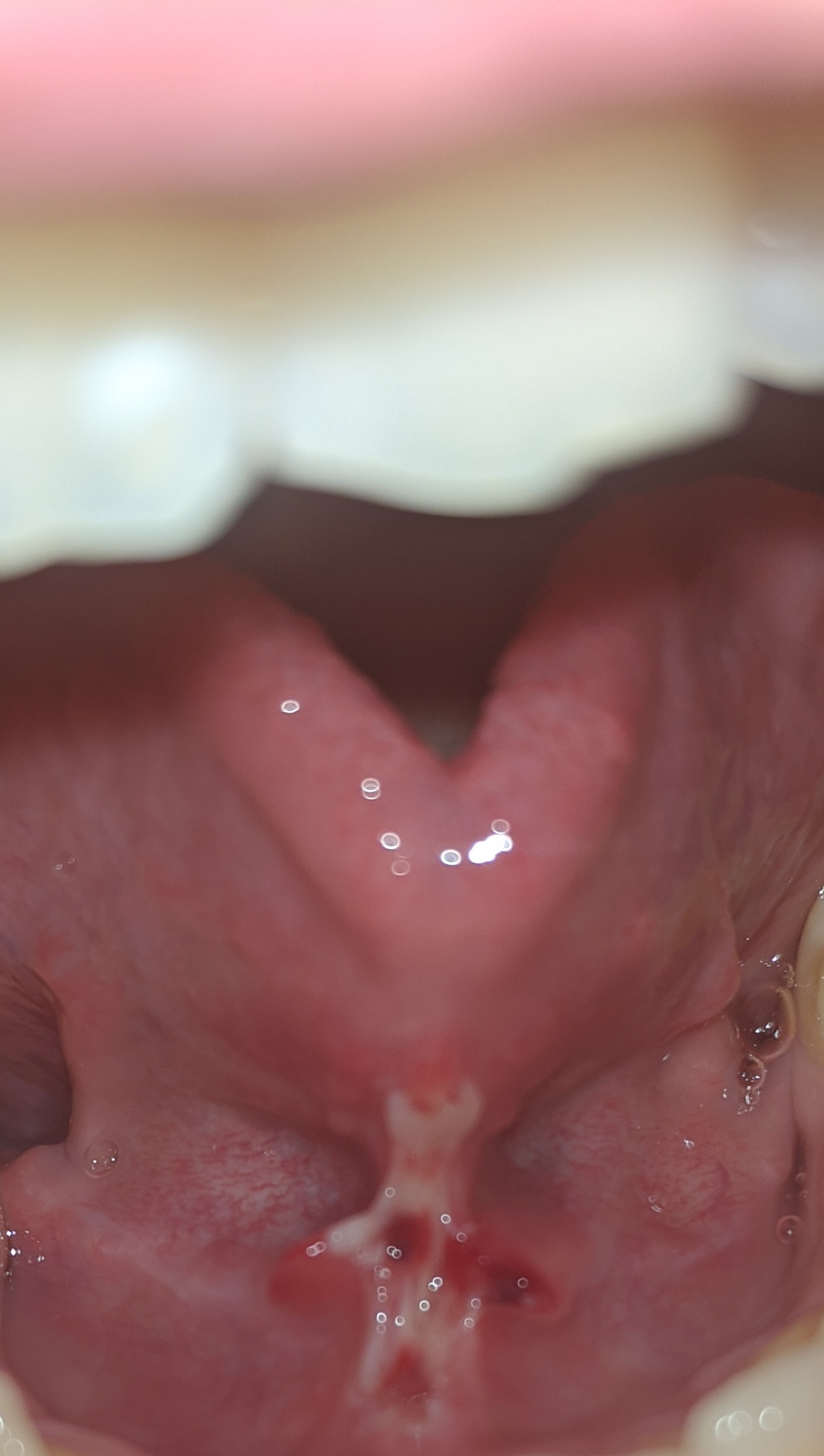 Ieri mi sono sottoposto al taglio attraverso un laser del frenulo sotto la lingua