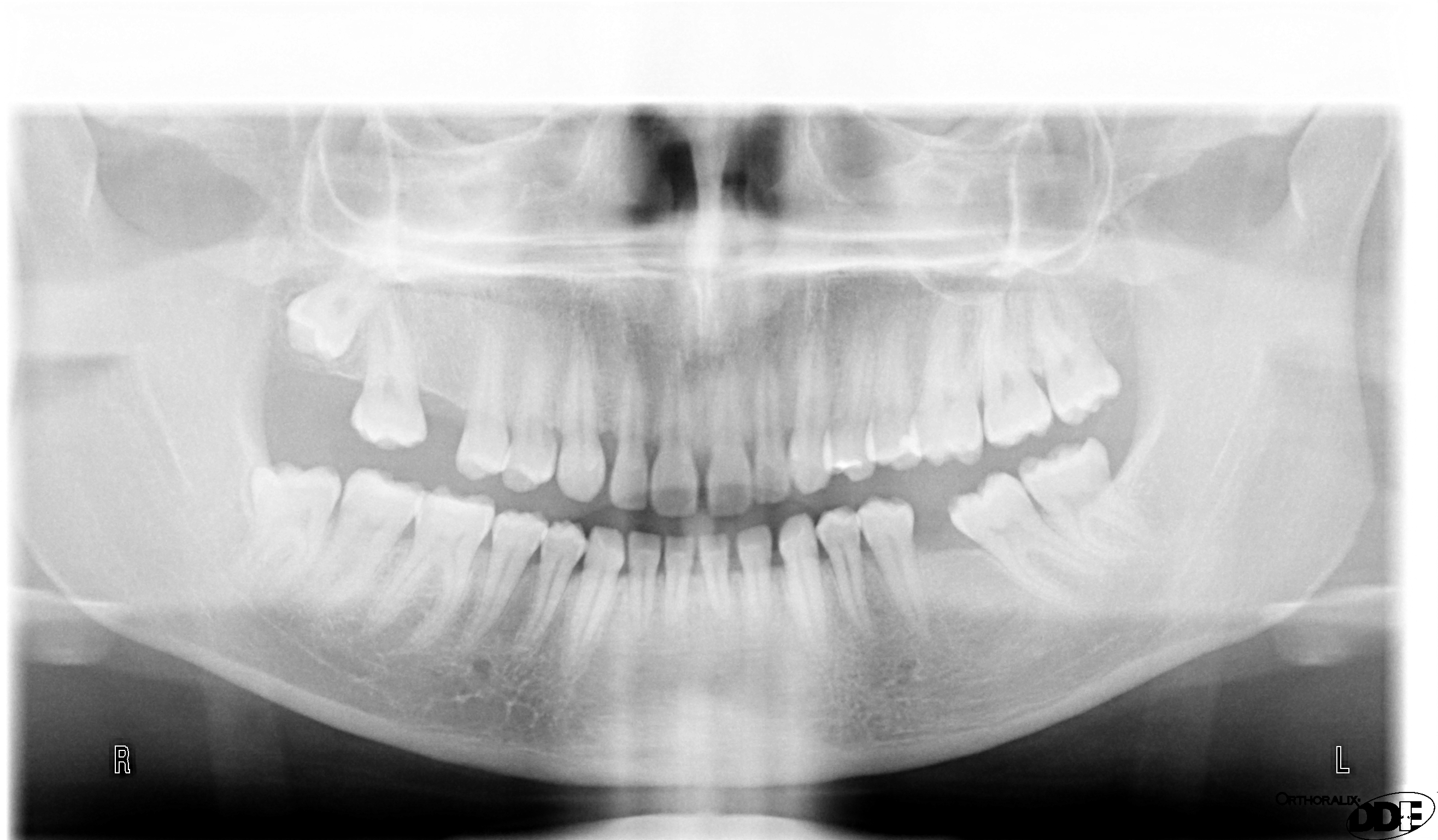 SEGUITO ALLA DOMANDA : MOBILITÃ DENTI DELLA SEMI ARCATA INFERIORE