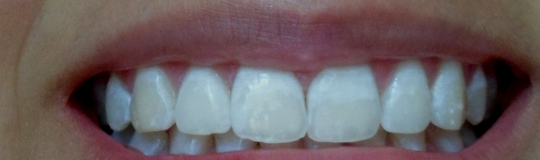 E' normale che dopo 24 ore i miei denti siano così?