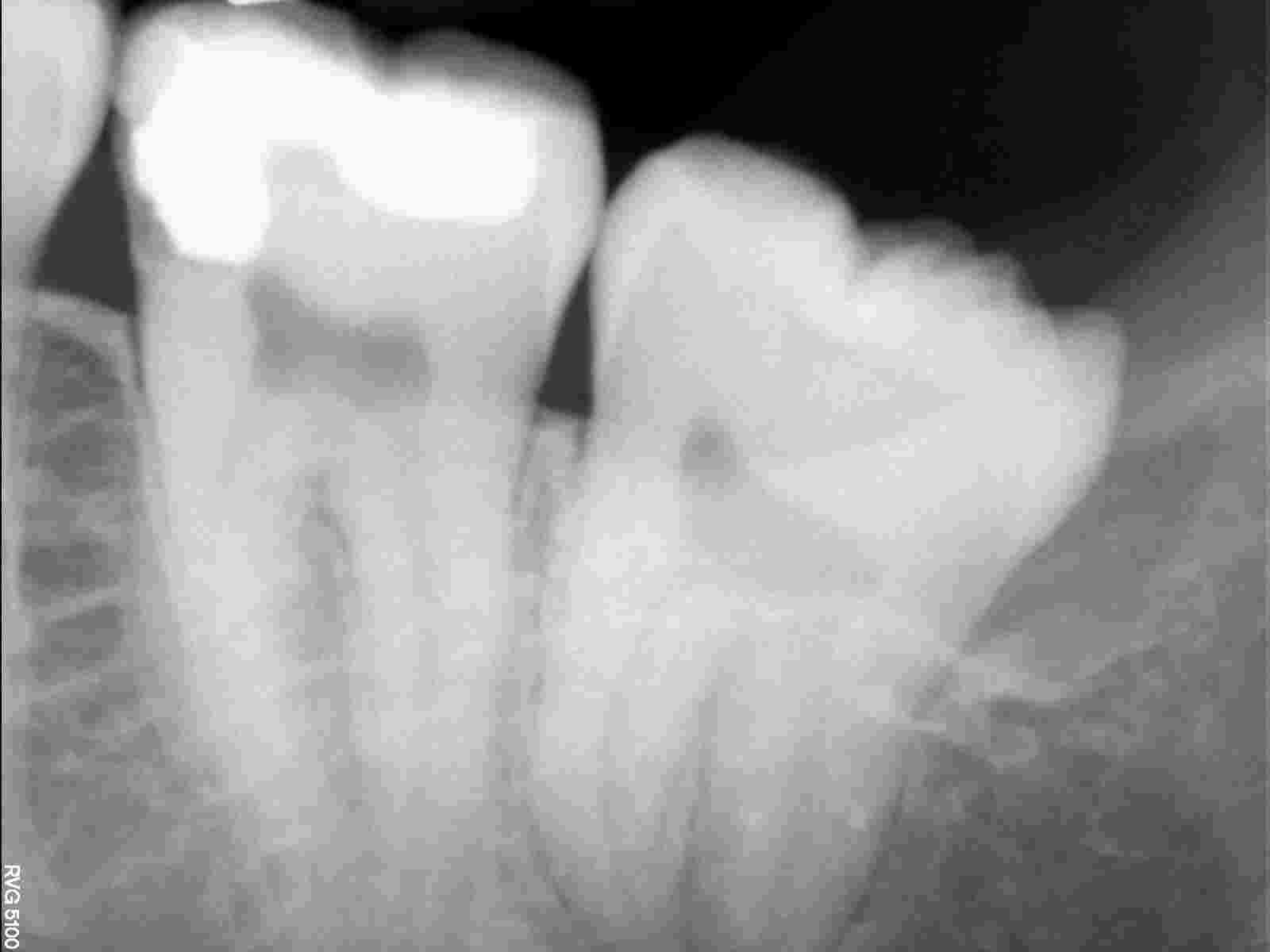 È normale che ci sia ancora l'ascesso visto che il dente è stato aperto 2gg fa?