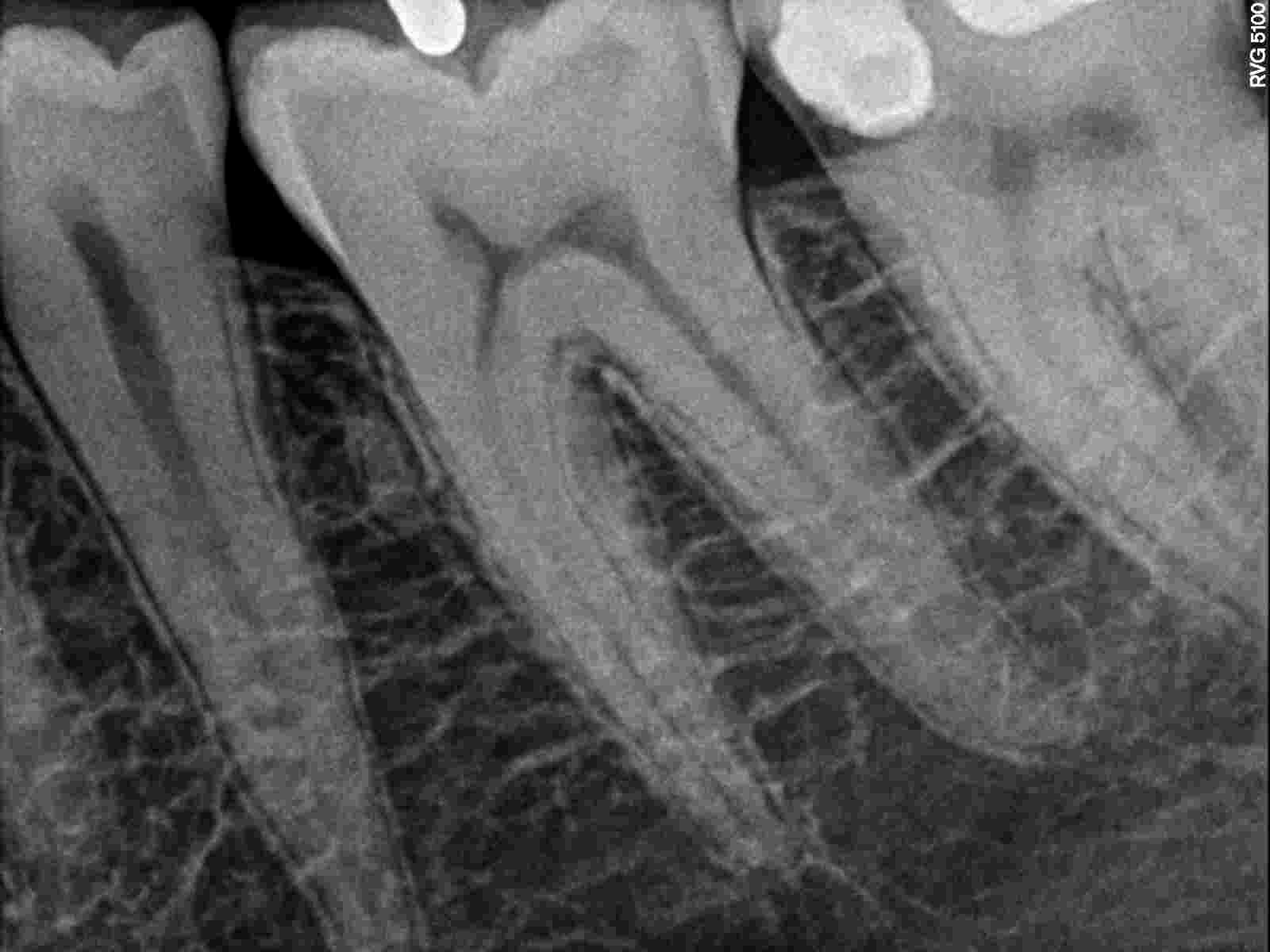 È normale che ci sia ancora l'ascesso visto che il dente è stato aperto 2gg fa?