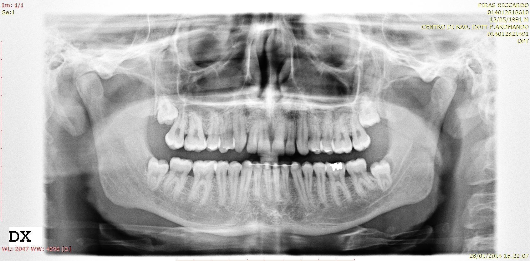 Circa 4 anni fa ho concluso una lunga terapia ortodontica per riportare un canino incluso in arcata
