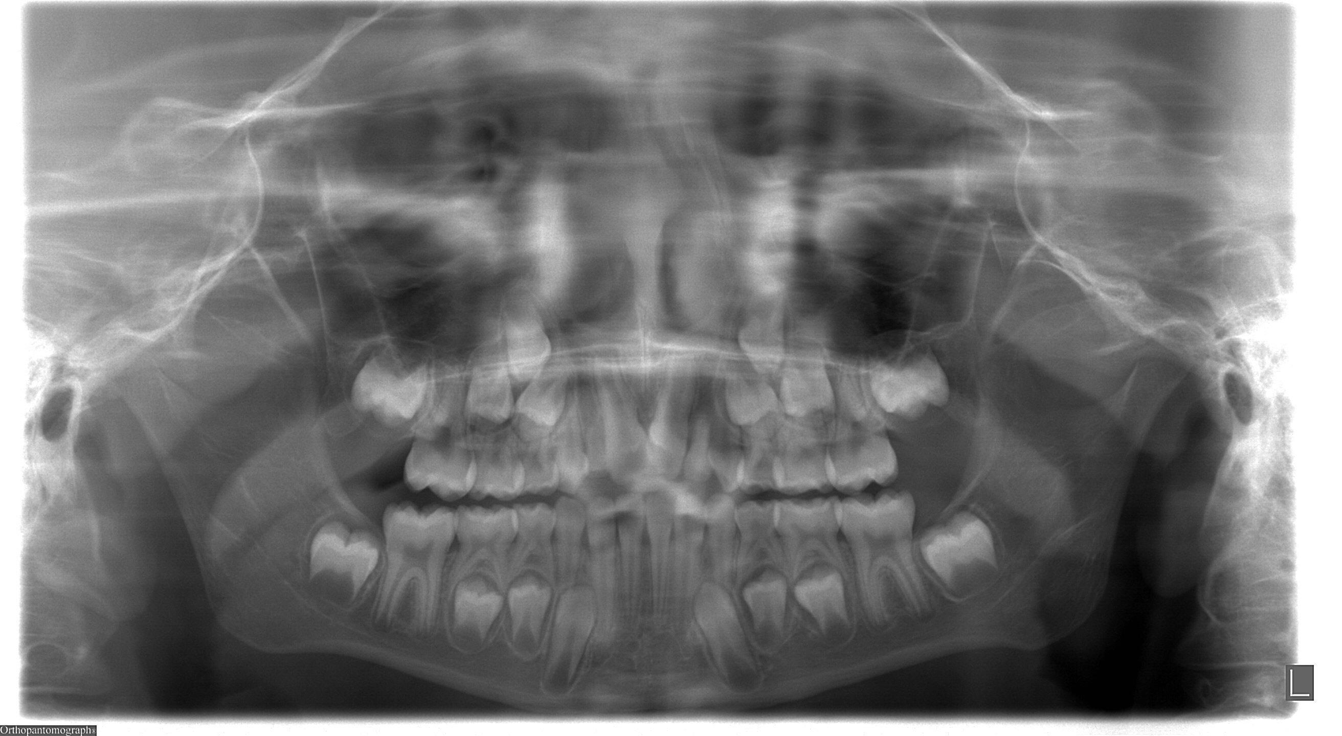 A mia figlia di 8 anni è stata diagnosticata un'agenesia degli incisivi laterali