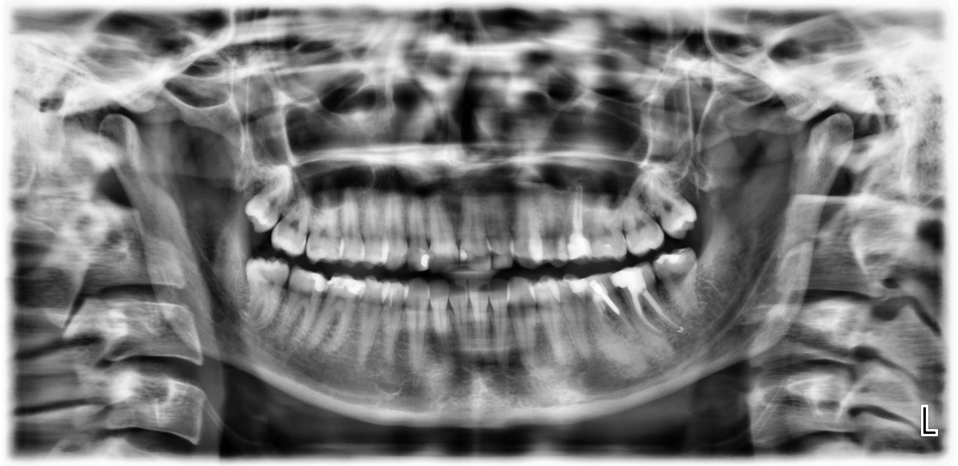 Dente da togliere o ridevitalizzare?