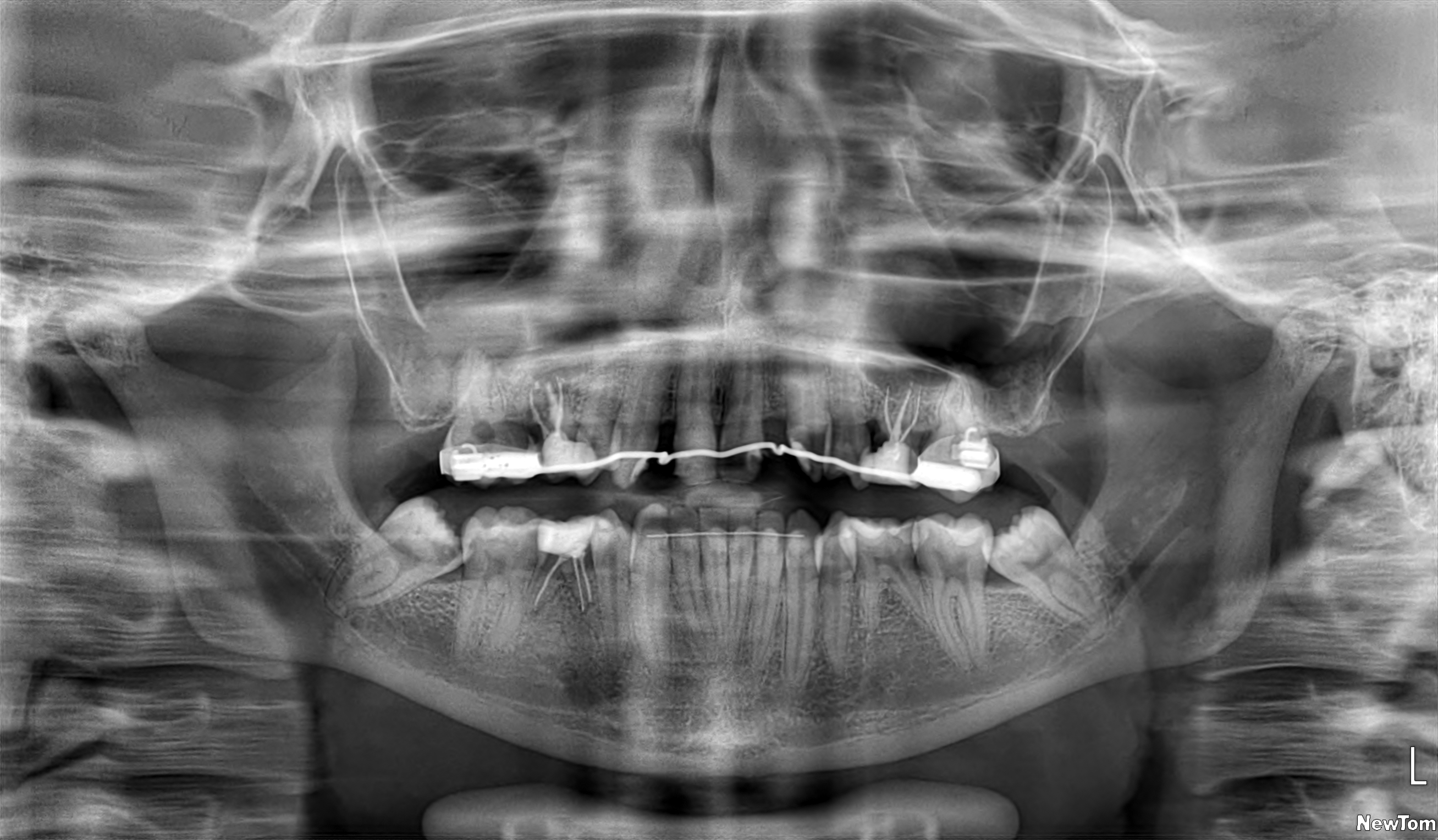 Riabilitazione dentale in caso di agenesie multiple