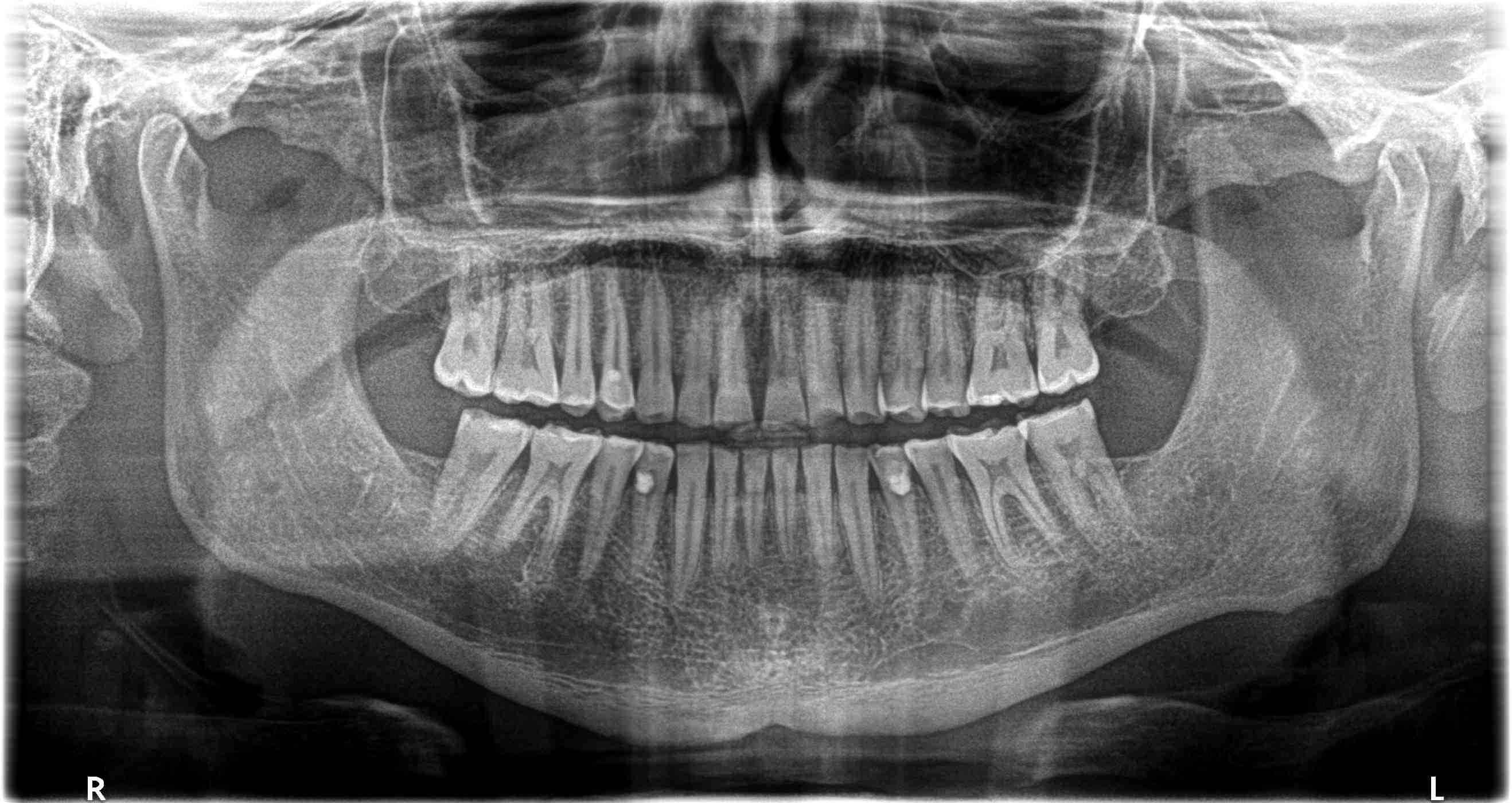 Causa forte bruxismo mi ritrovo a 41 anni con tutti i denti consumati