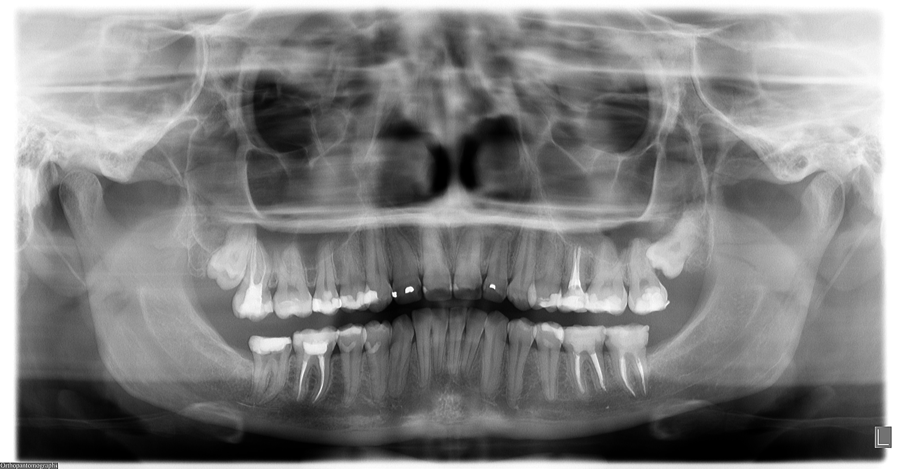 ortopantomografia_delle_arcate_dentarie.jpg