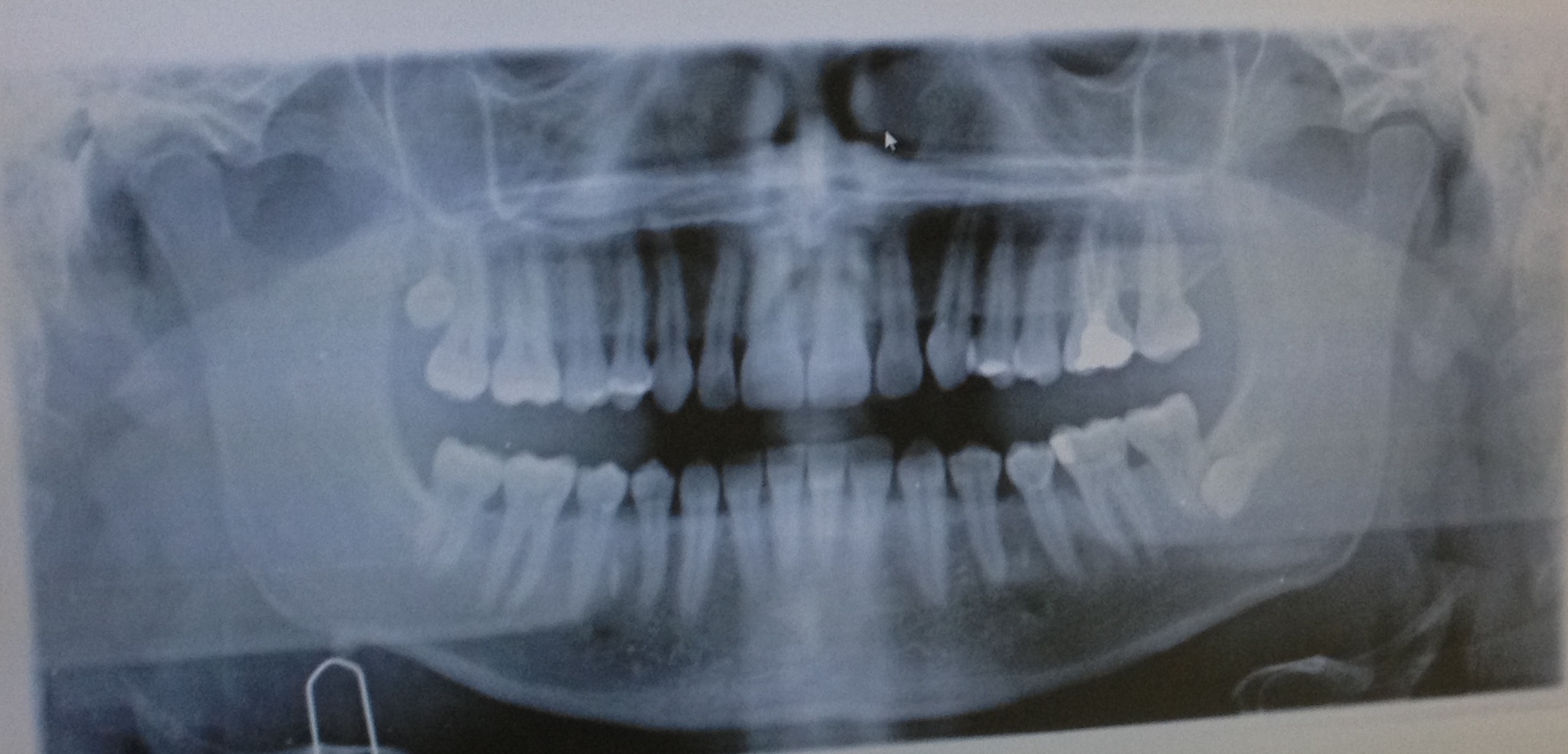 Ho un dente del giudizio inferiore totalmente incluso che impatta con la radice del settimo