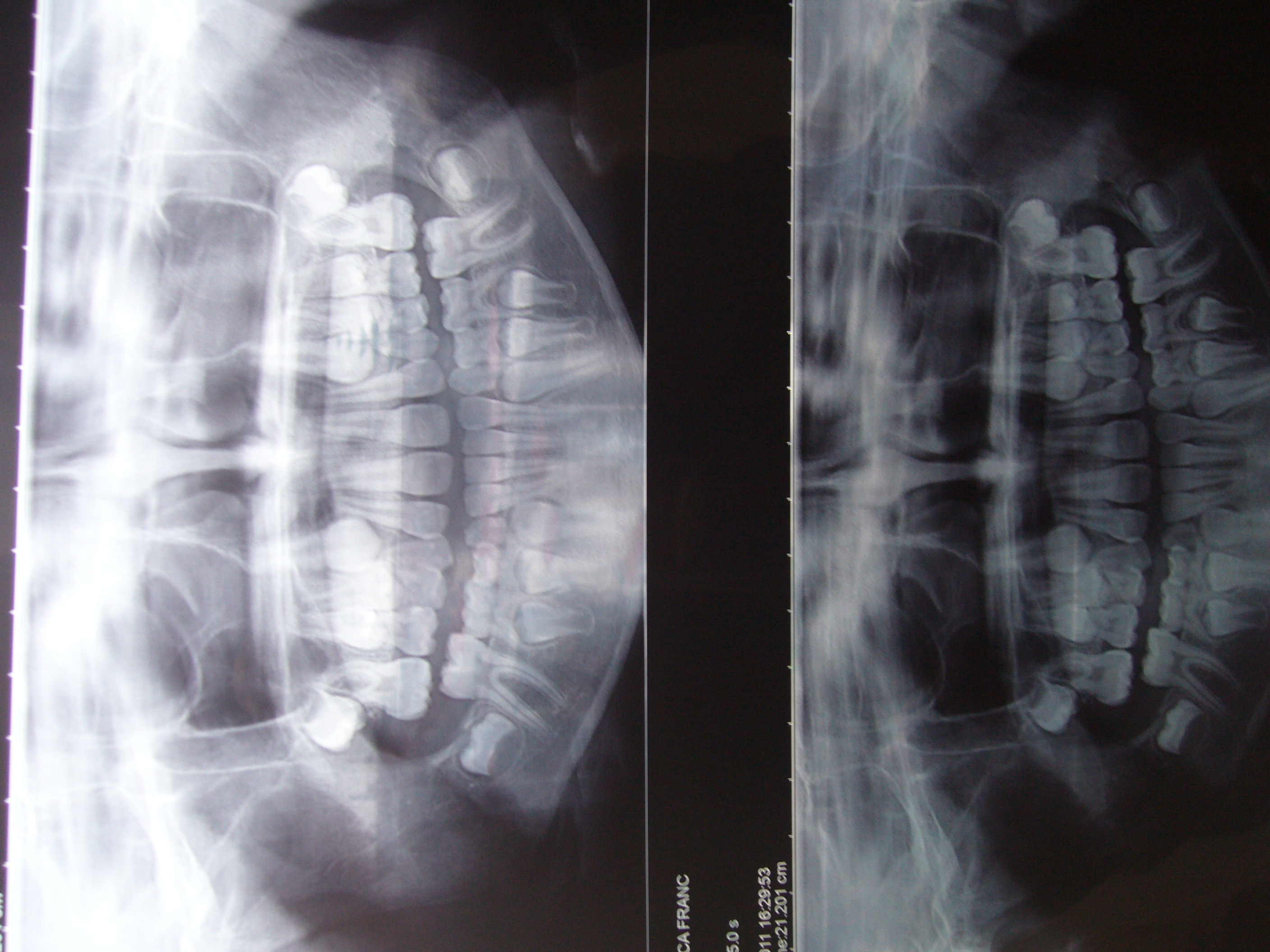 Mia figlia di 10 anni ha una malocclusione dentoscheletrica di 3 classe