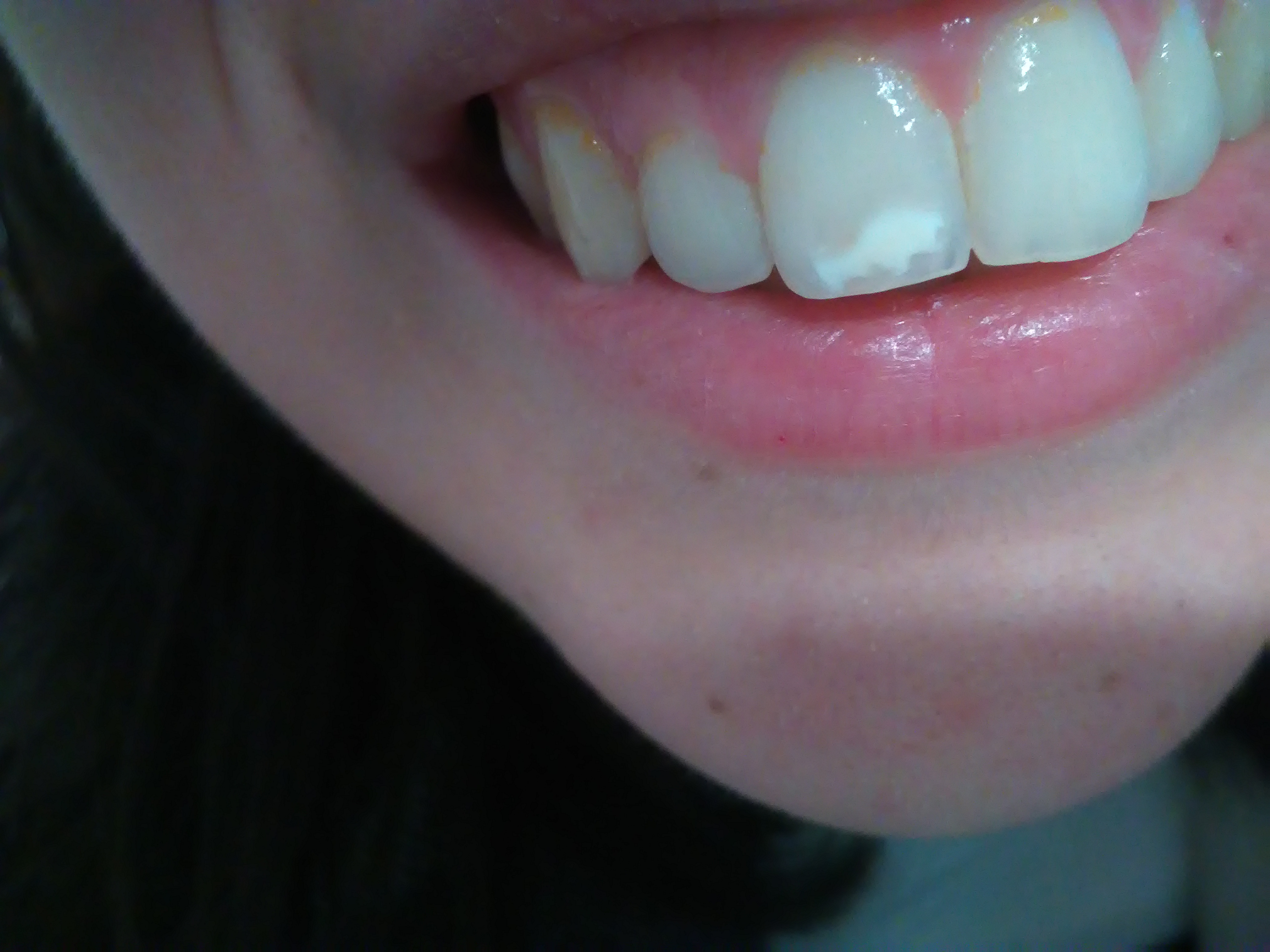 Patina arancione sui denti superiori: è rimovibile, cosa potrebbe essere?