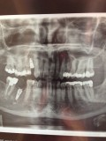 Impianti dentali: Che conseguenze può avere tutto questo?