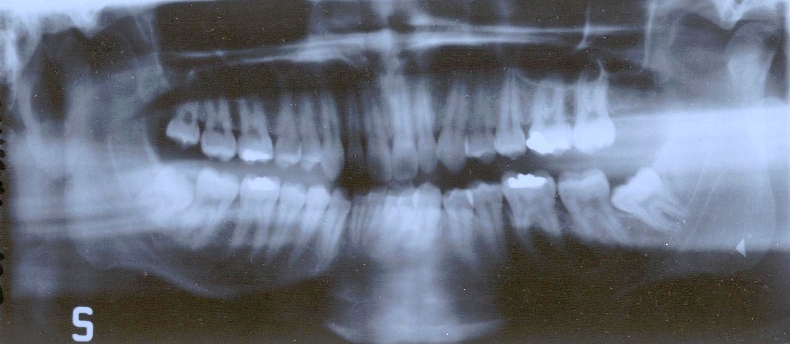 Ortodonzia e denti del giudizio