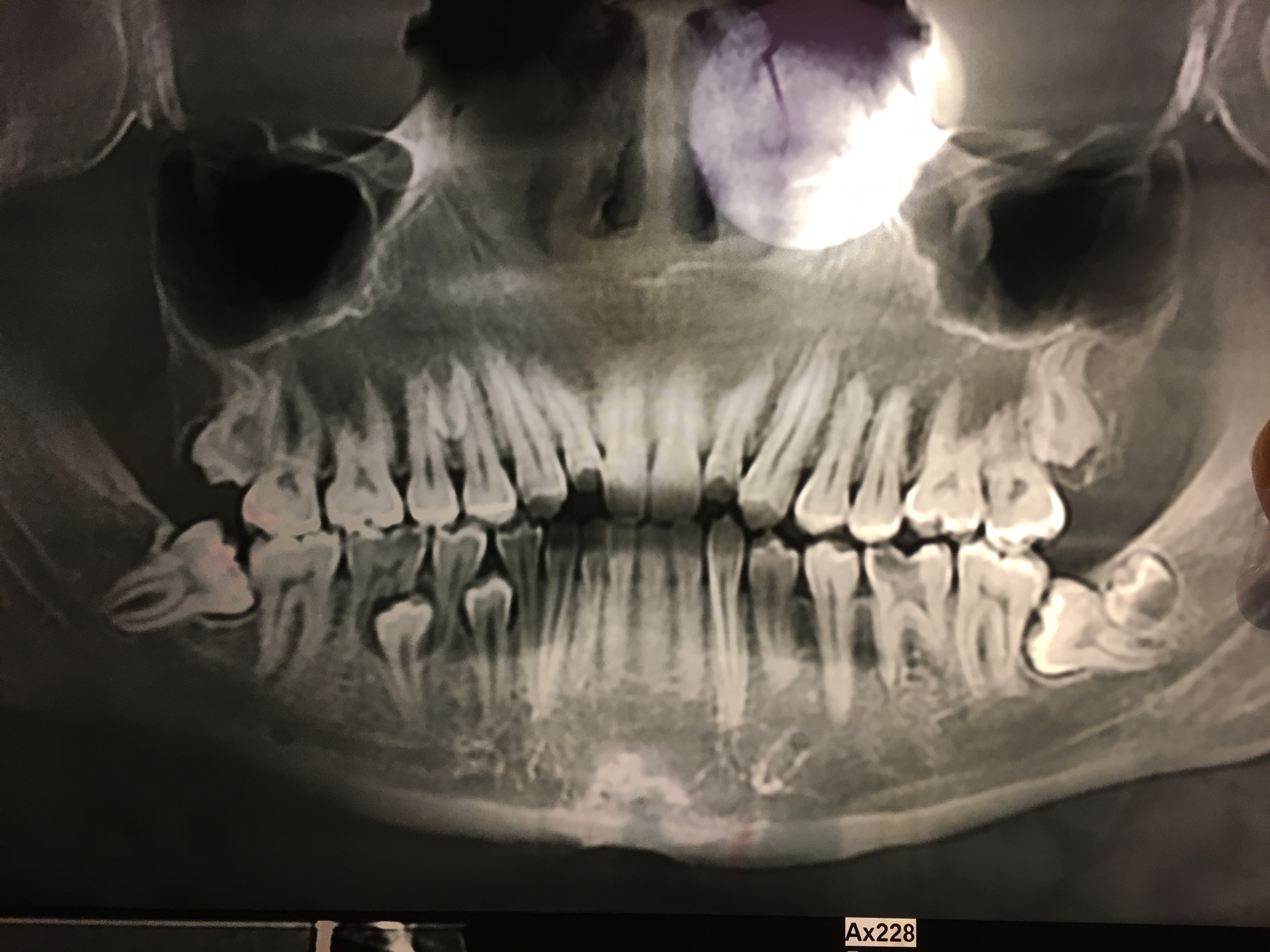 Ho 4 denti soprannumerari inclusi