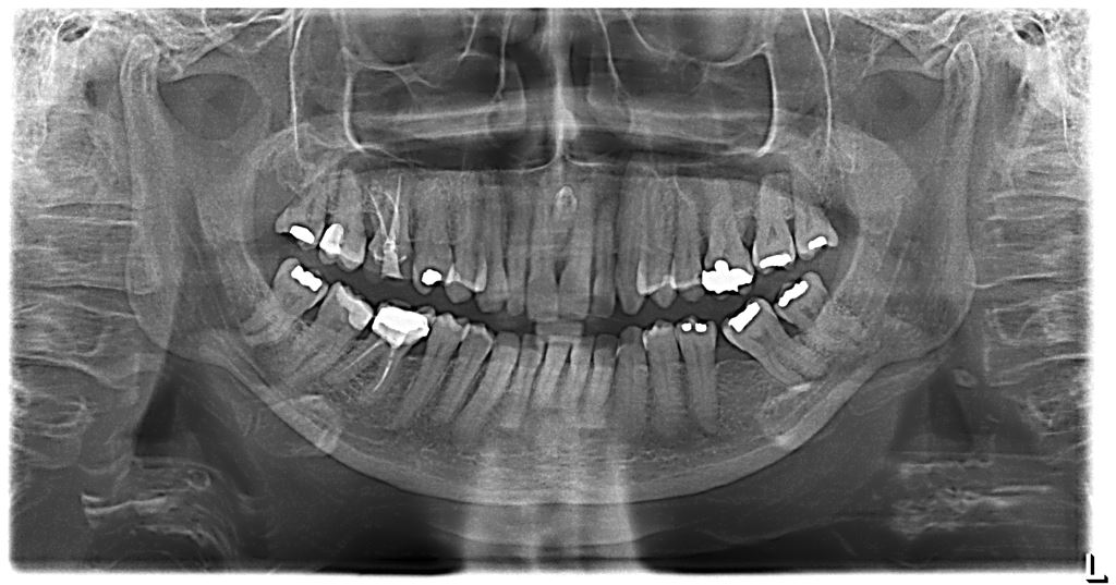 Ortopanoramica con sospetta osteorarefazione