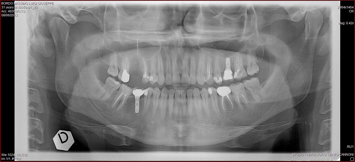 A causa di un dolorosissimo granuloma ad un molare superiore lato destro ho subito un paio di settimane fa l'estrazione dello stesso