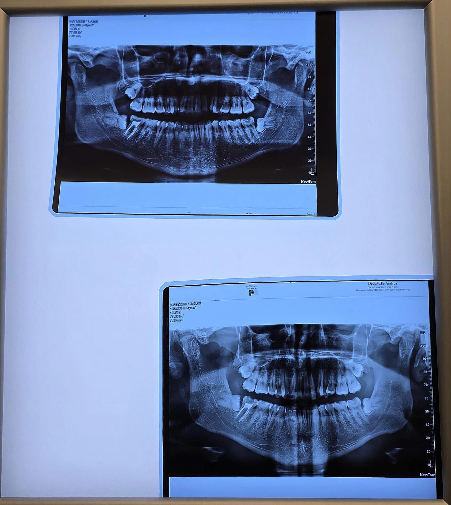 Radice del dente del giudizio lasciata nel seno mascellare: rischi e dubbi
