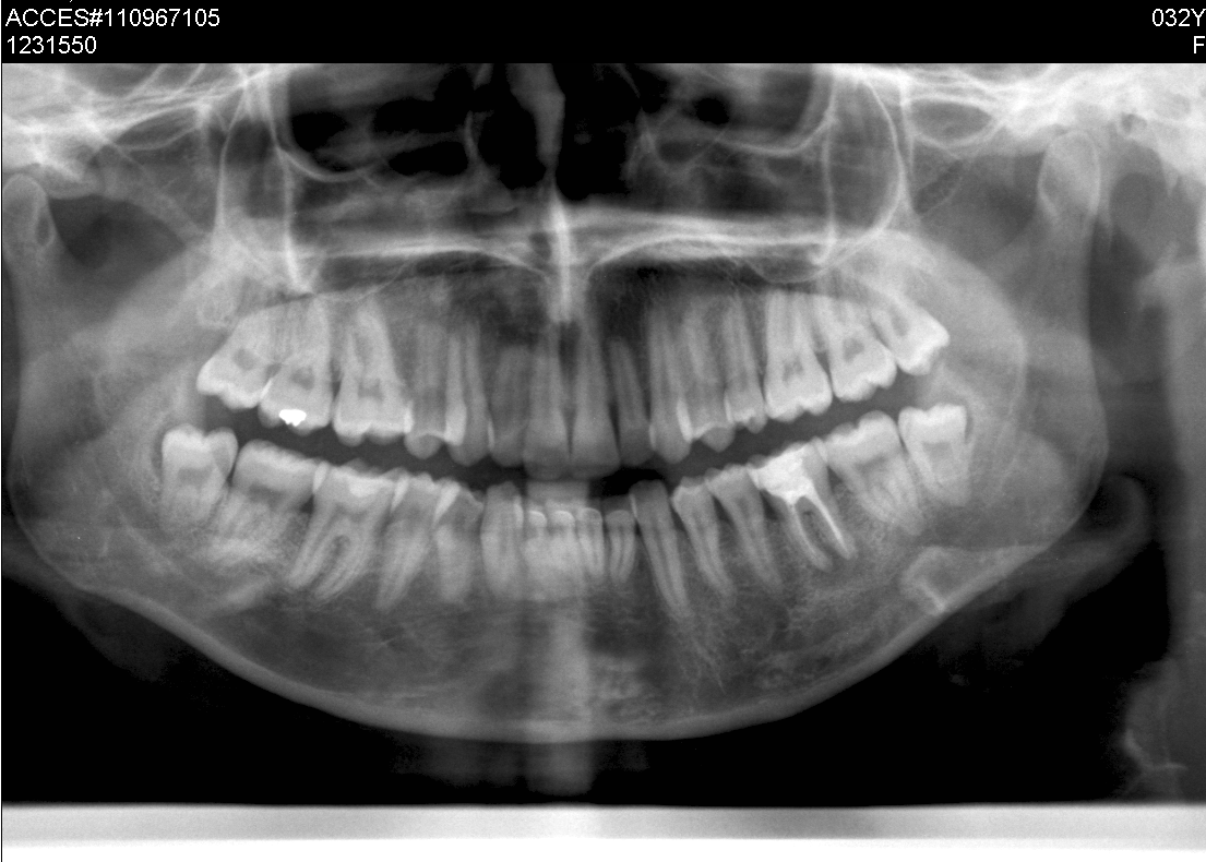 Io non ho dolori di nessun tipo al dente ma mi è stato consigliato di togliere questa ciste...