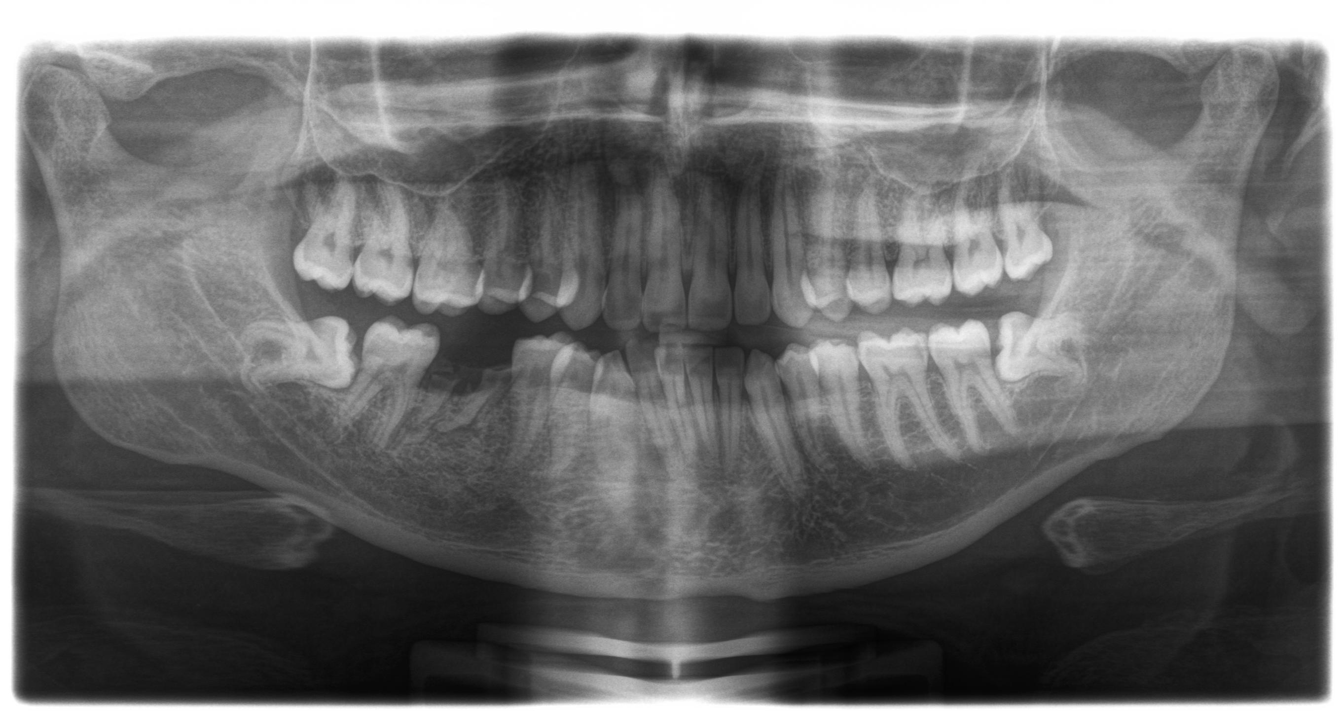 E' veramente necessario togliere quei 2 denti?