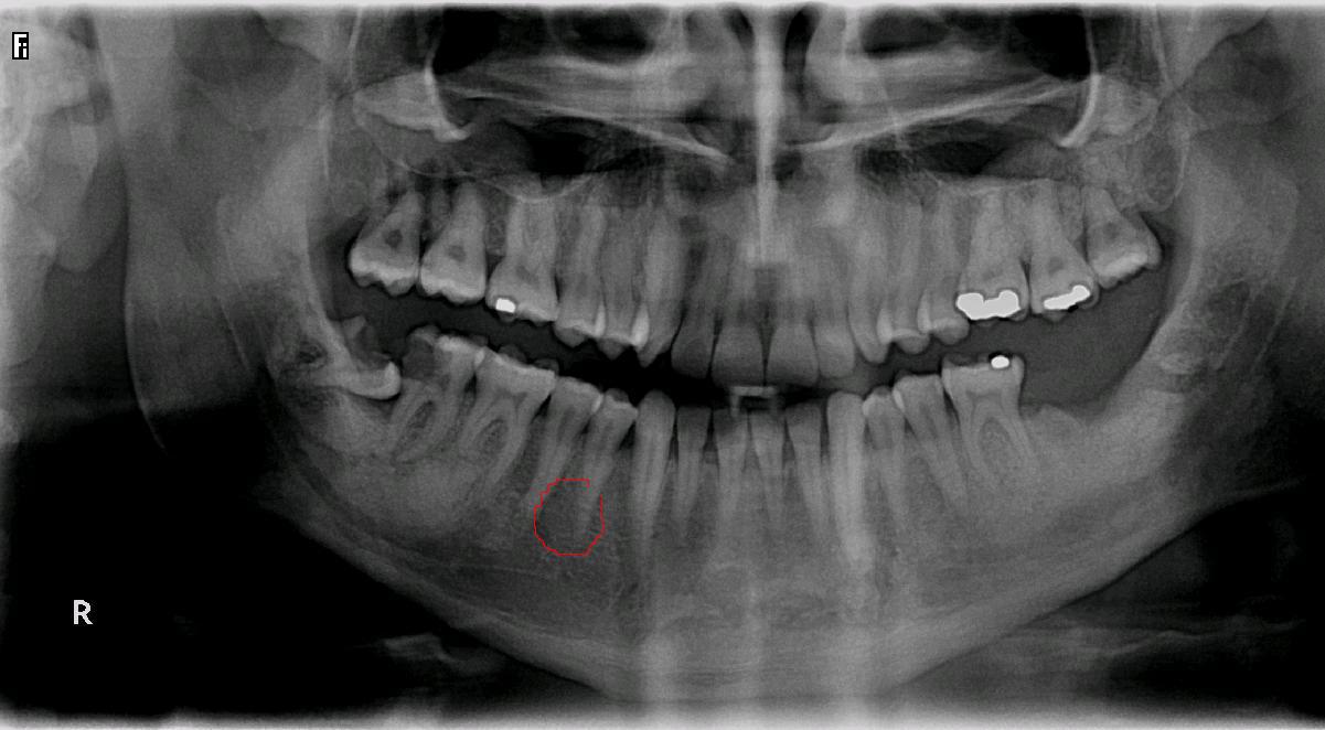 Seguito domanda del 31/10/2008: Estrazione denti e impianti post estrattivi