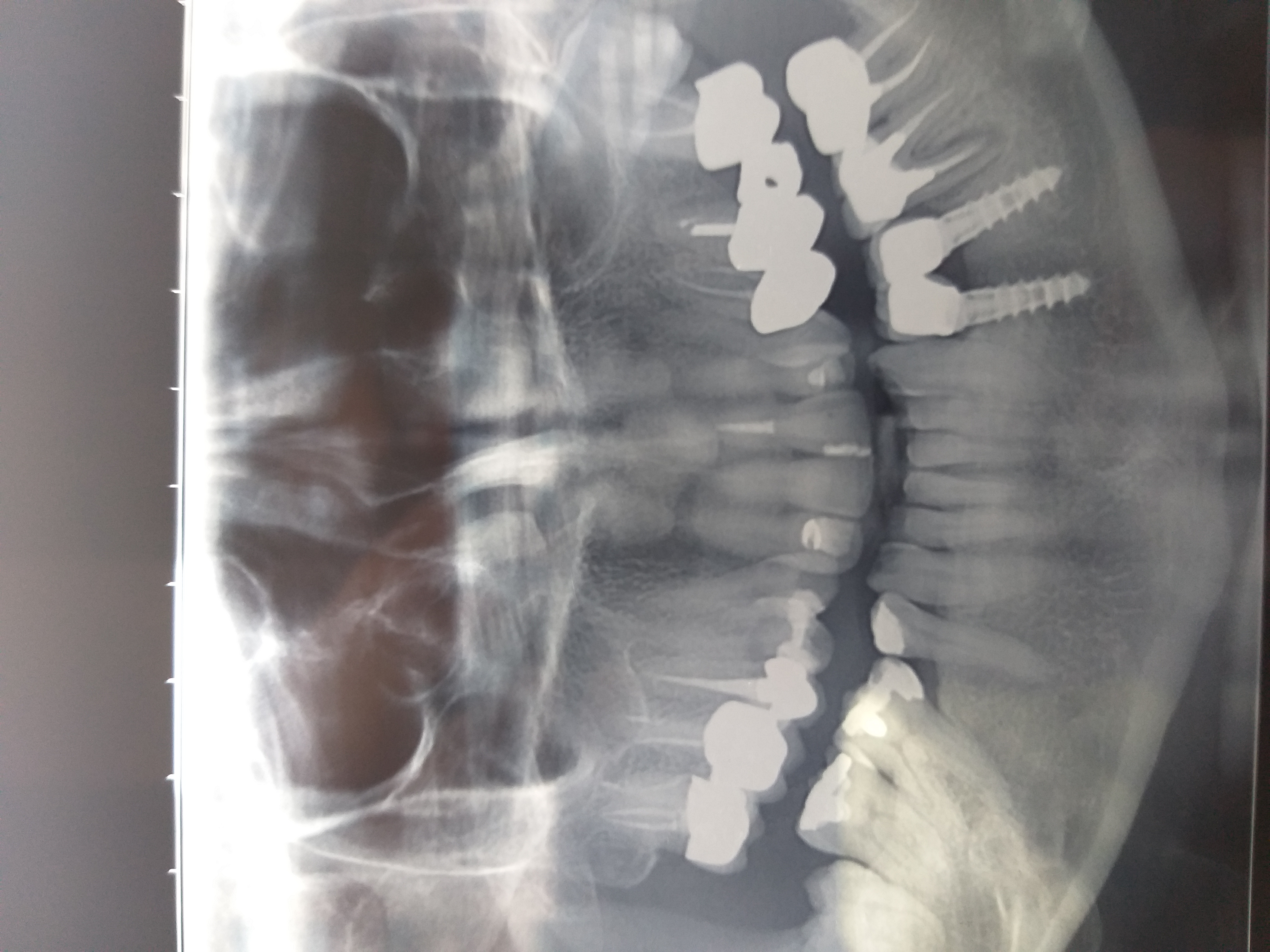 Togliere un dente  buono per inserire un impianto