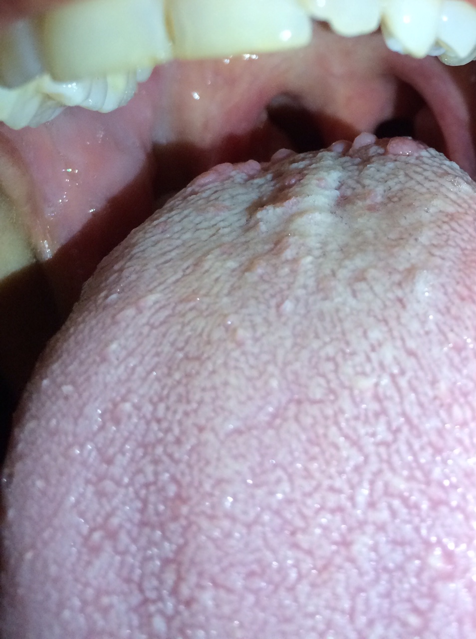 Ho iniziato ad avvertire sintomi riconducibili a quelli della bocca urente