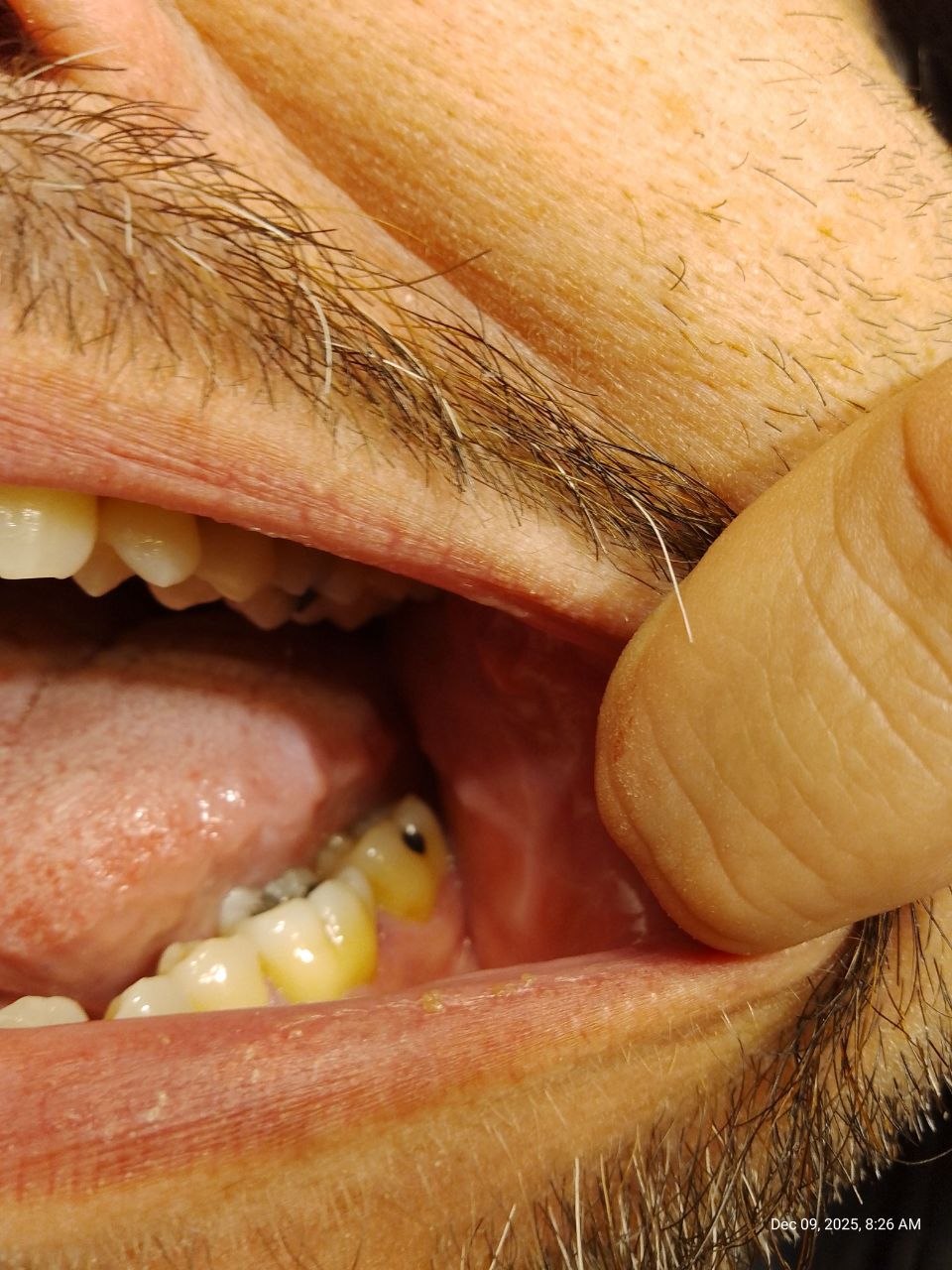 È una vecchissima otturazione o una possibile carie?