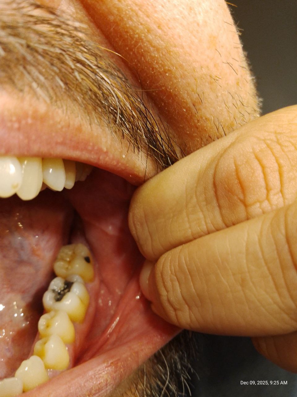 È una vecchissima otturazione o una possibile carie?