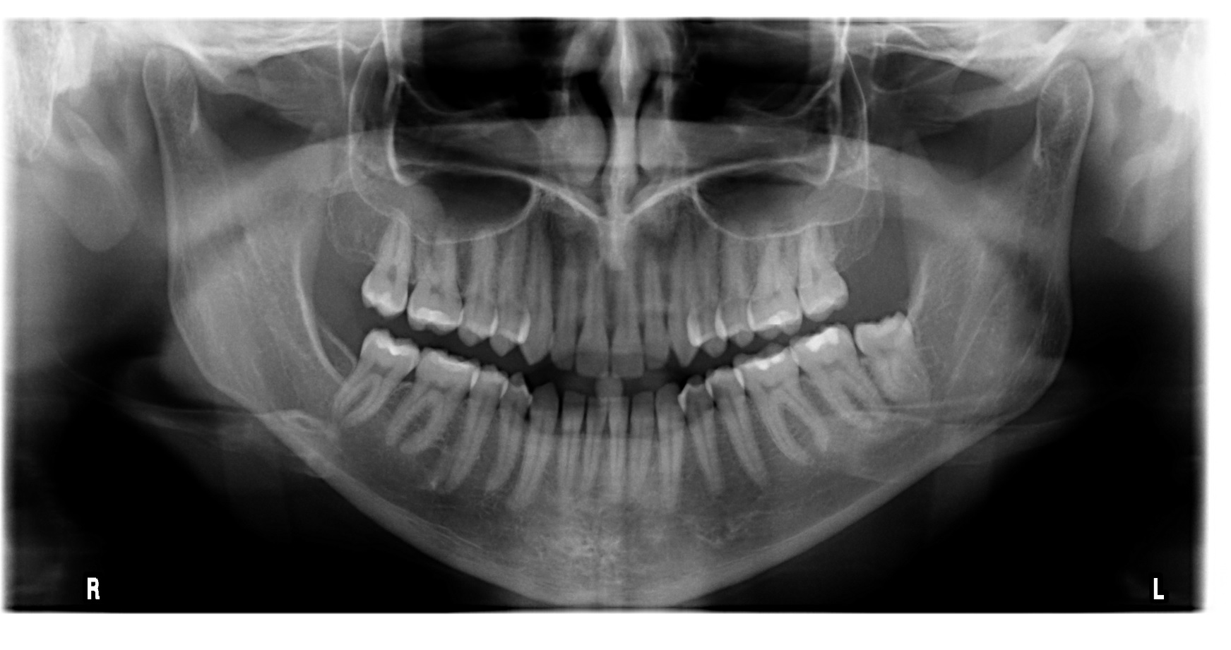 Dal giorno dopo l'otturazione inizio a sentire dolore al dente